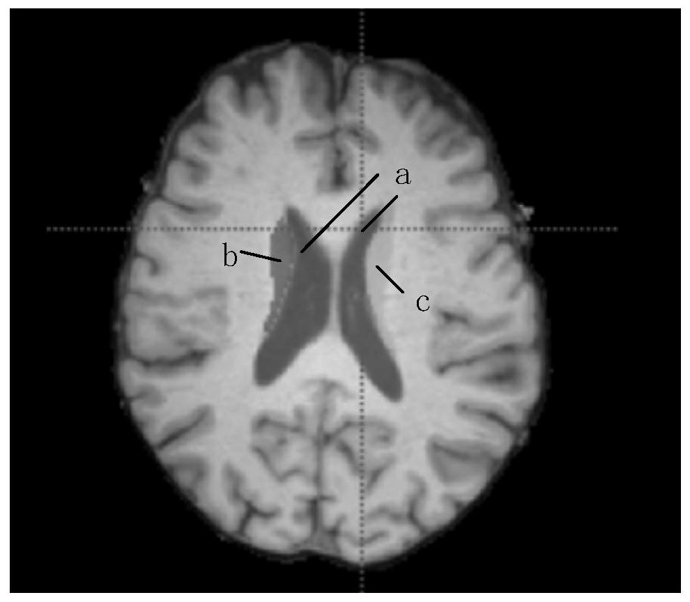 Training method and device for improving ventricular segmentation model, electronic equipment and medium