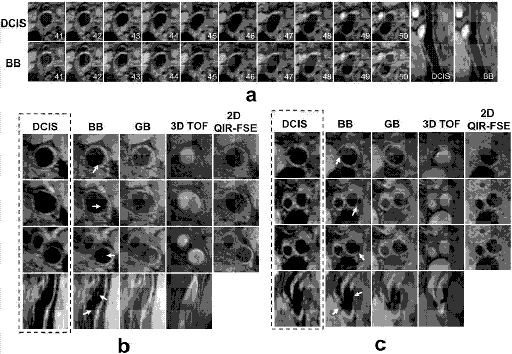 Blood flow artifact removing method for carotid magnetic resonance blood vessel wall imaging