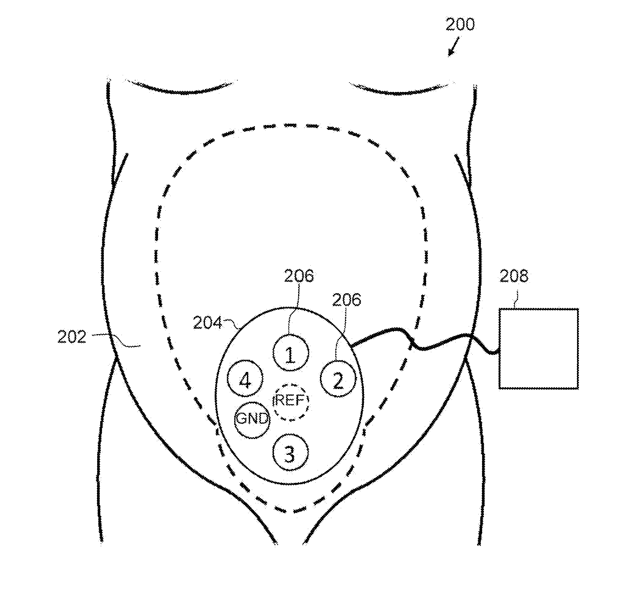 Electrophysiological monitoring of uterine contractions