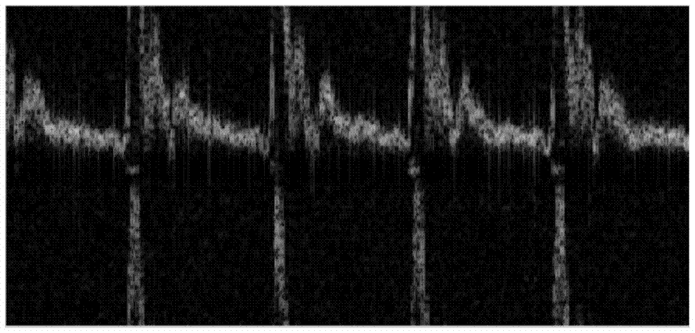 Ultrasonic system Doppler signal gap interpolation method and system