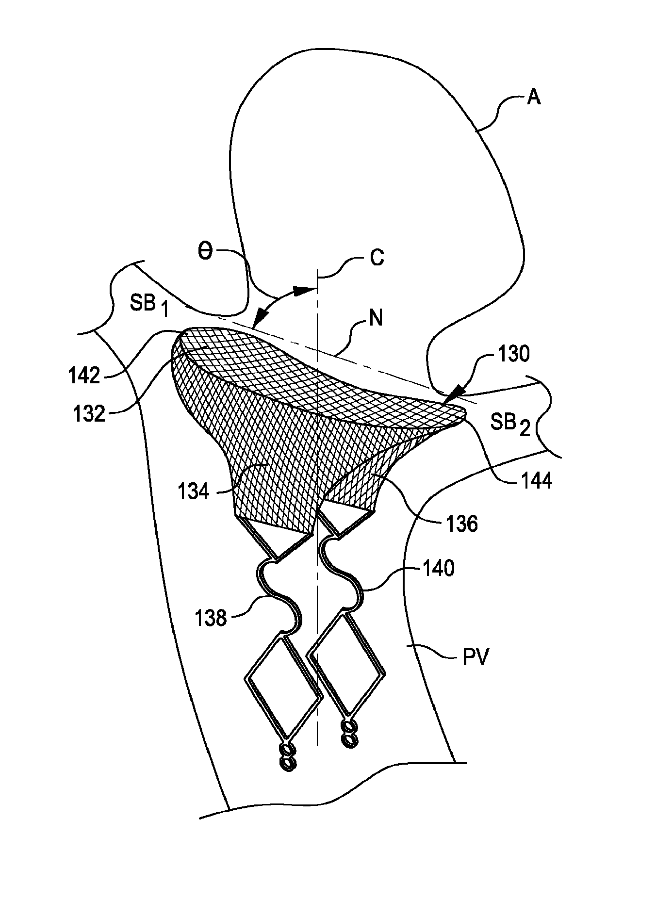 Systems and methods for supporting or occluding a physiological opening or cavity