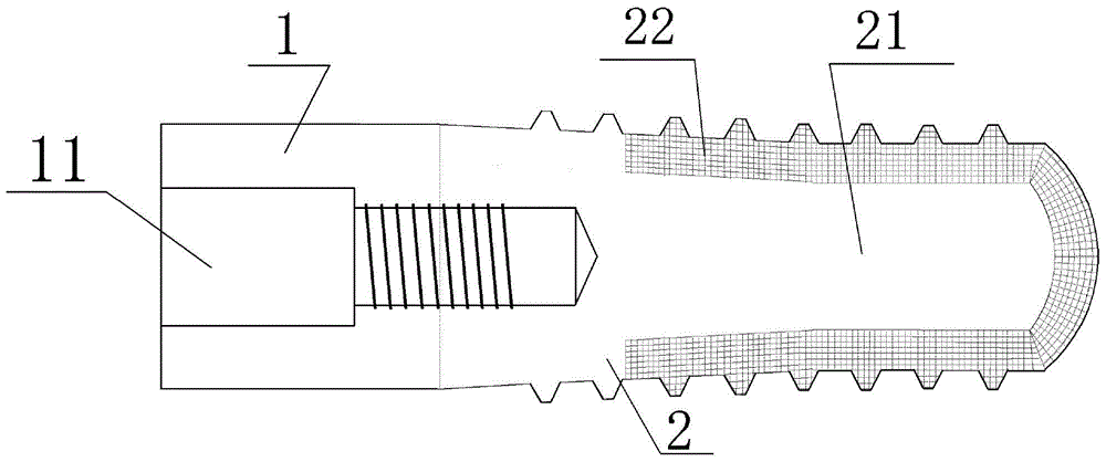 Method for designing and manufacturing individual 3D printed implant