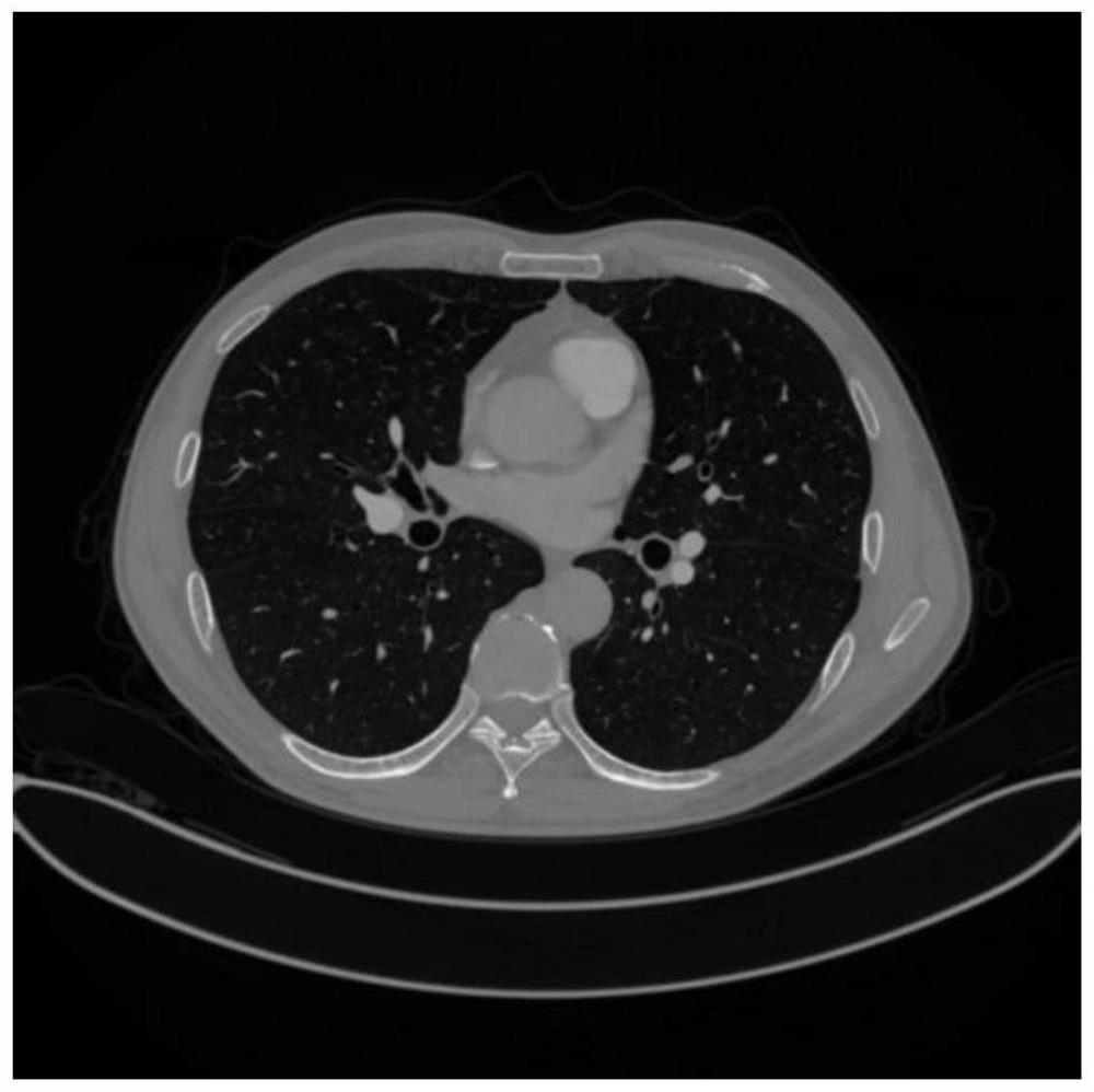 A Segmentation Method of CT Chest X-ray Lung Tissue Image Based on Level Set