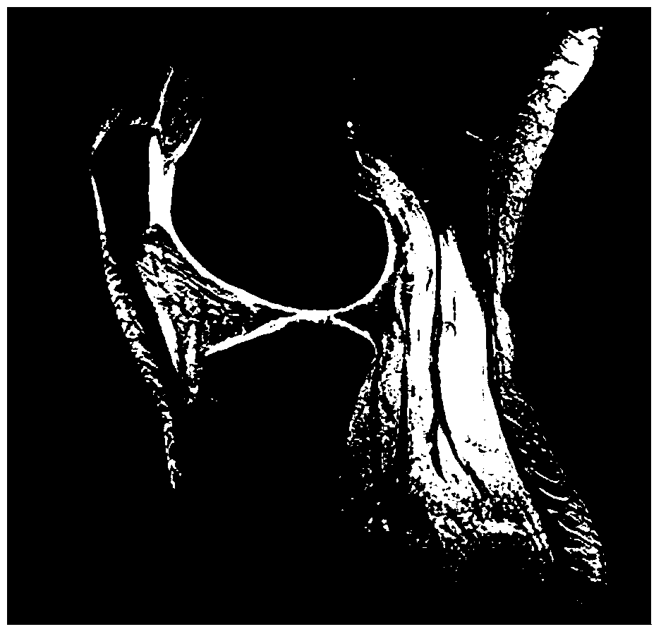 Automatic segmentation method of knee joint cartilage image