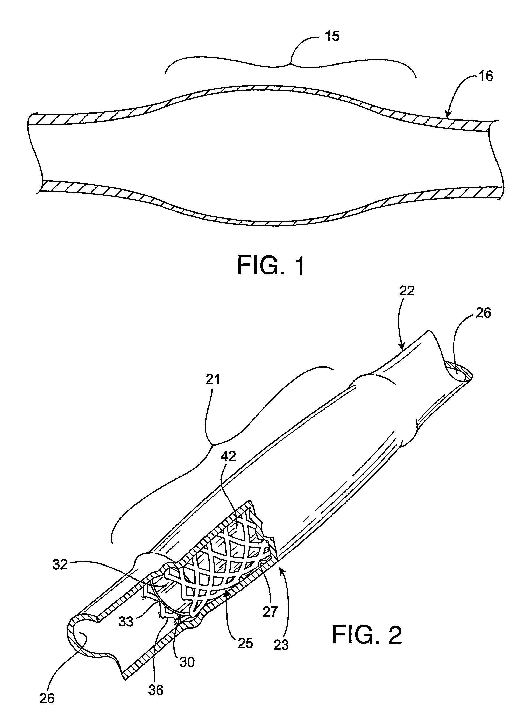 Radioactive intraluminal endovascular prosthesis and method for the treatment of aneurysms