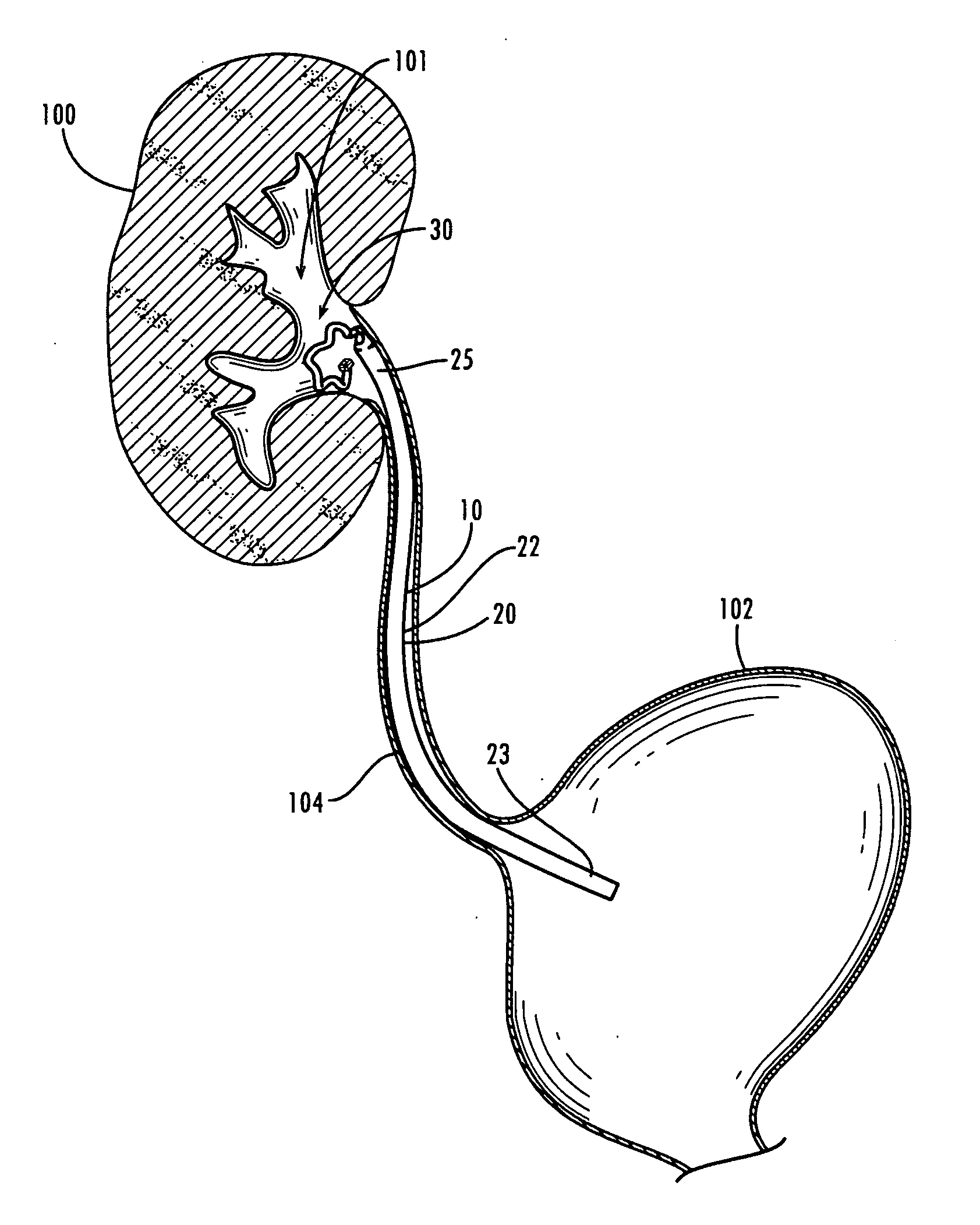 Stent kidney curl improvements