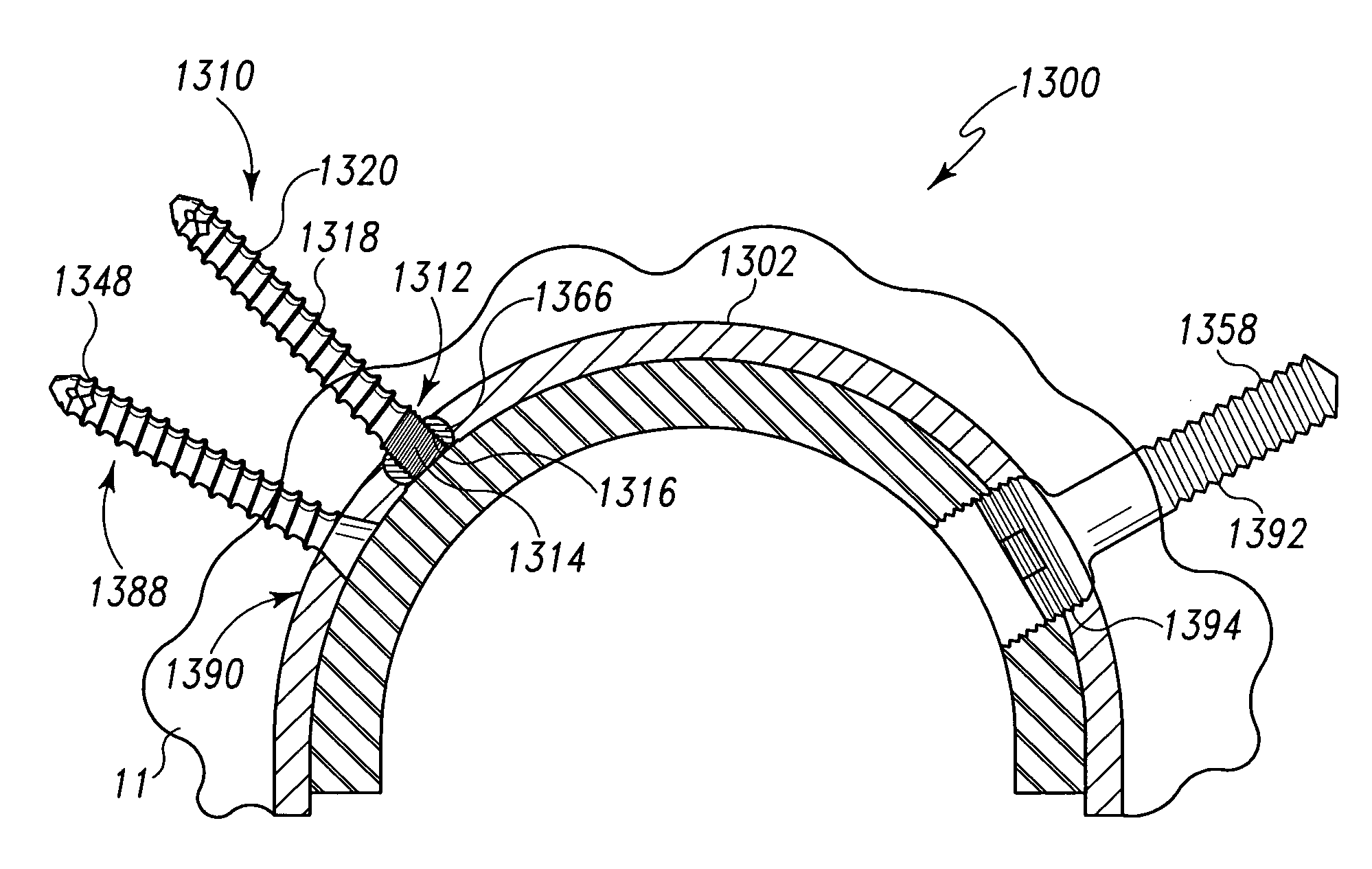 Acetabular cup with rigid fasteners