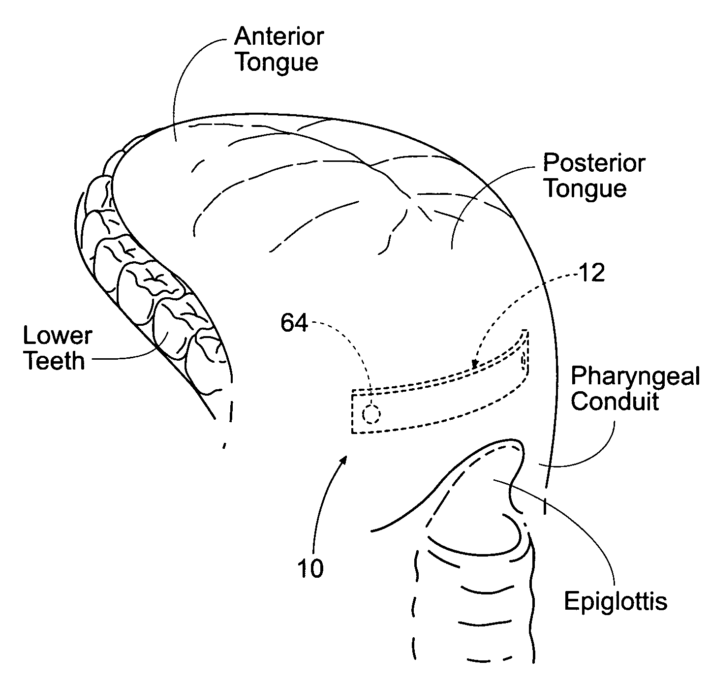 Devices, systems, and methods to fixate tissue within the regions of body, such as the pharyngeal conduit