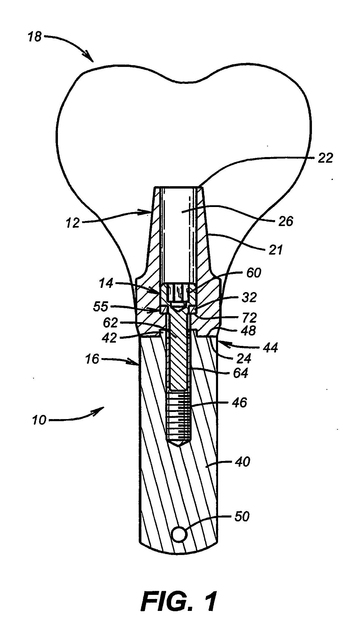 Abutment screw with spring-washer