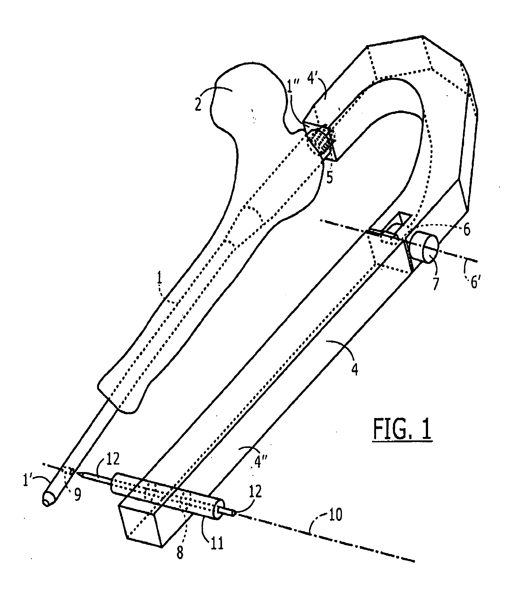 Aiming Arm for Locking of Bone Nails