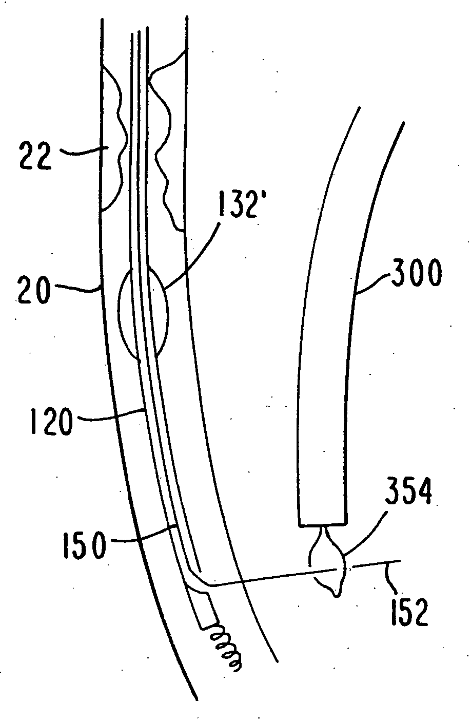 Medical grafting methods and apparatus