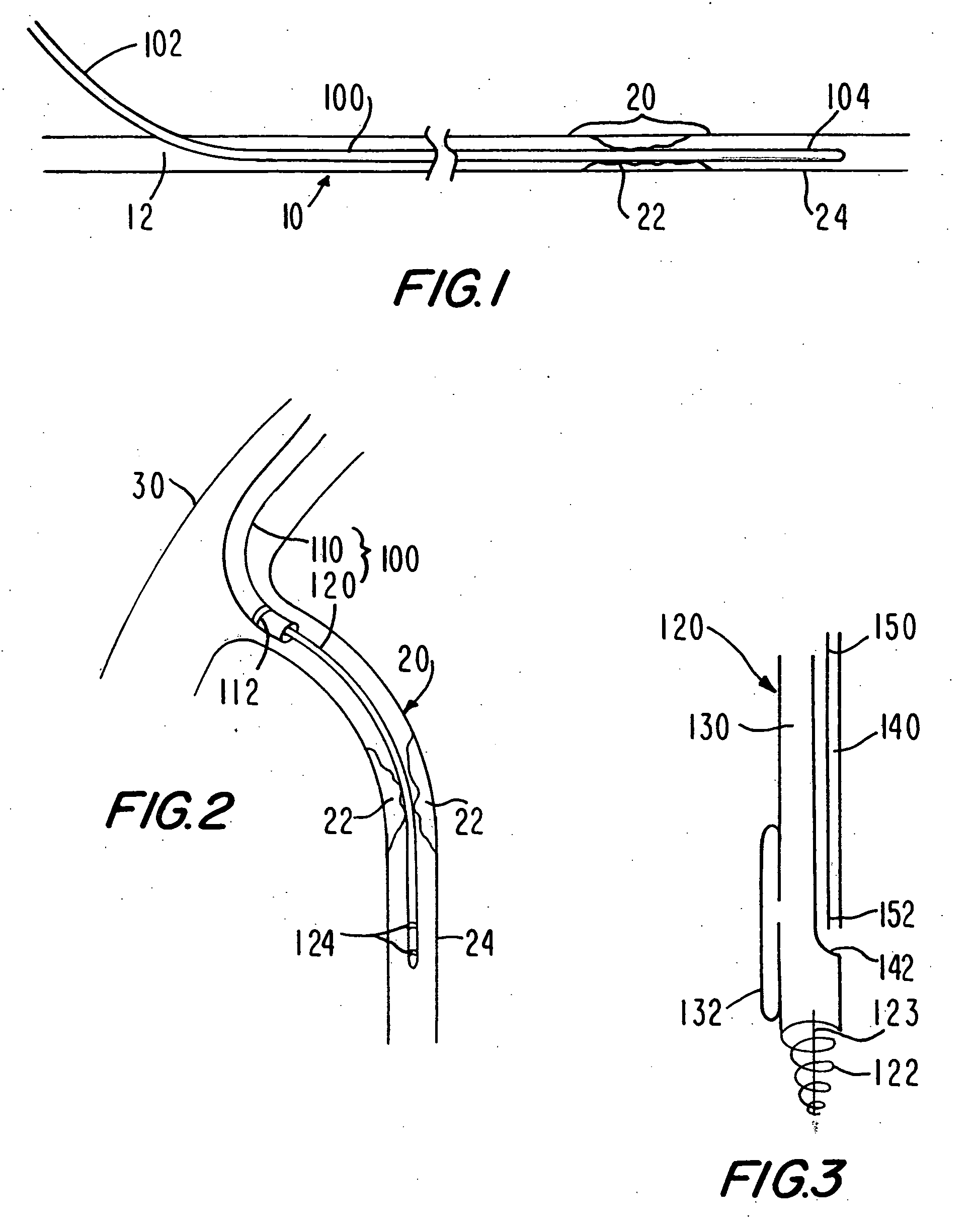 Medical grafting methods and apparatus