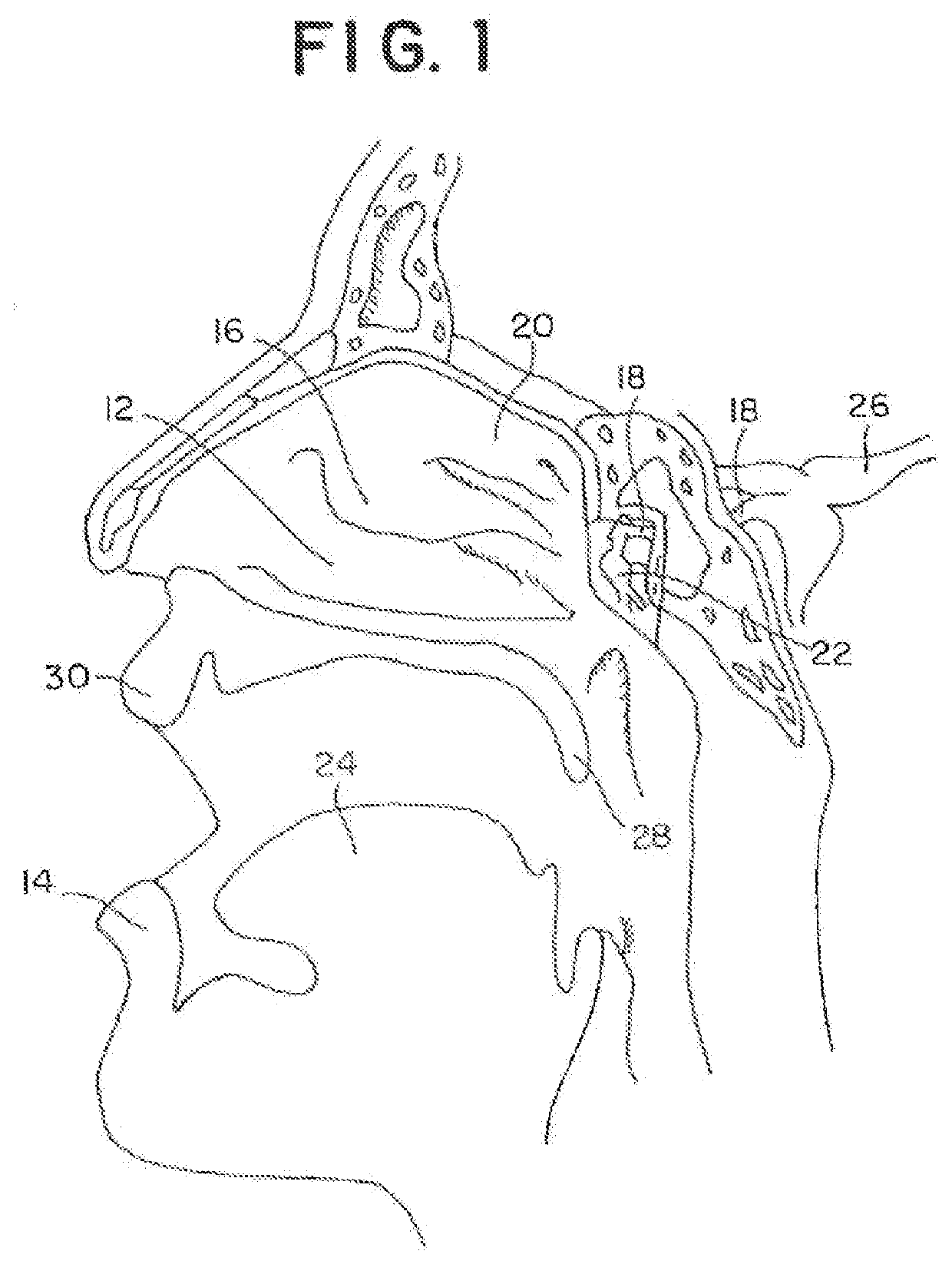 Materials and methods for treating neuropathies and related disorders including those involving a keystone nerve