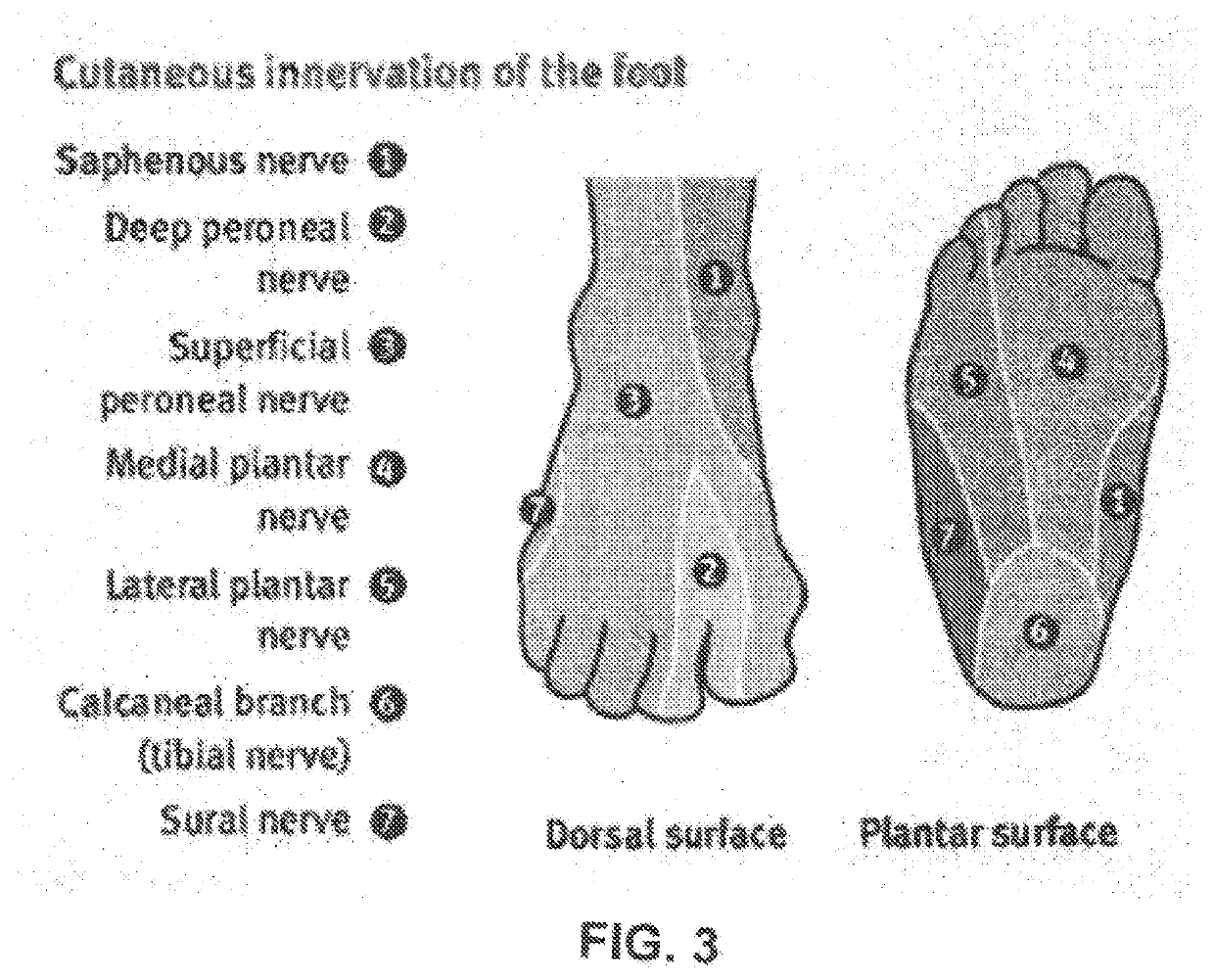 Materials and methods for treating neuropathies and related disorders including those involving a keystone nerve