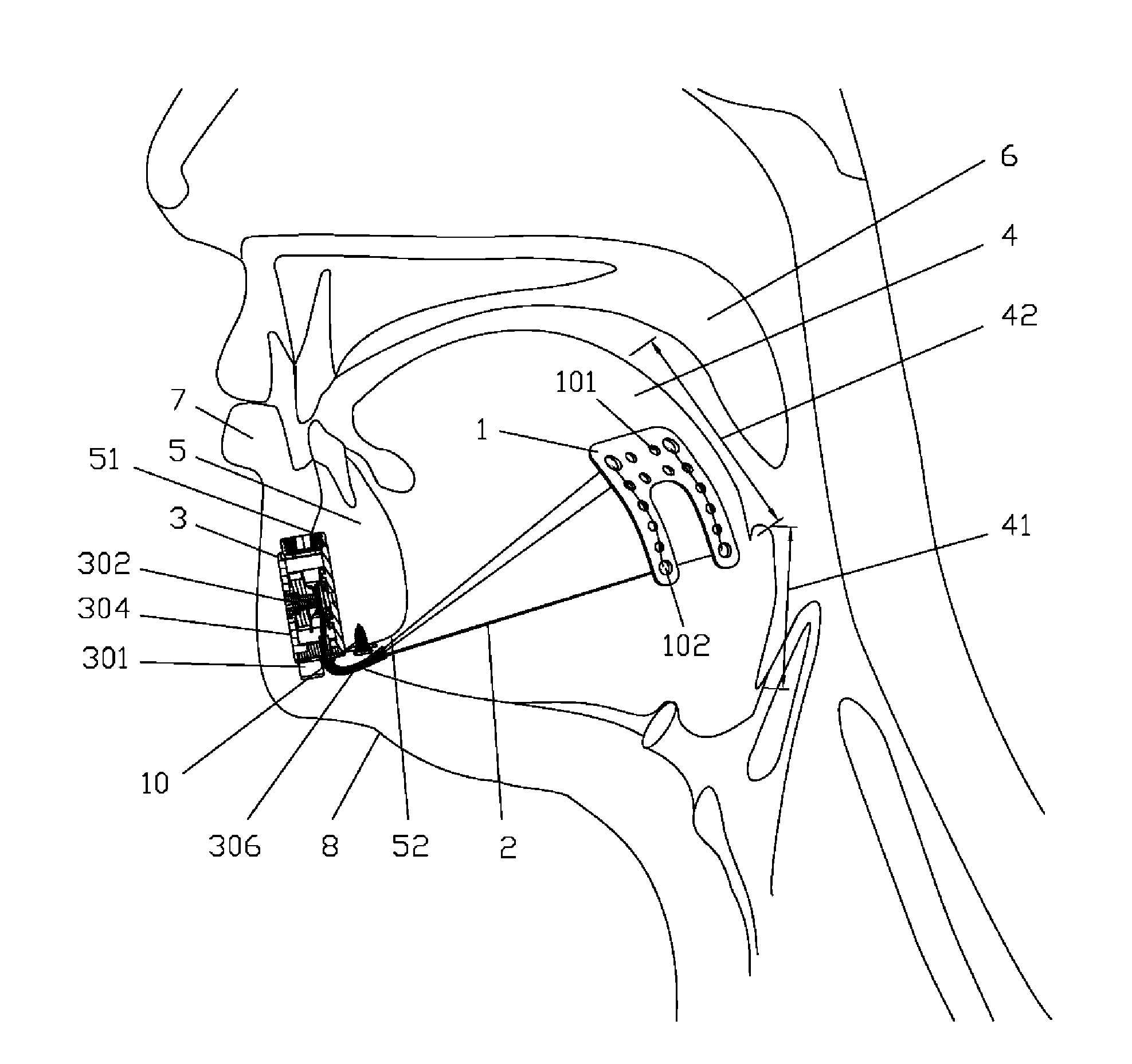 Implanted tongue pulling device, pull plate, pull line, retractor and method