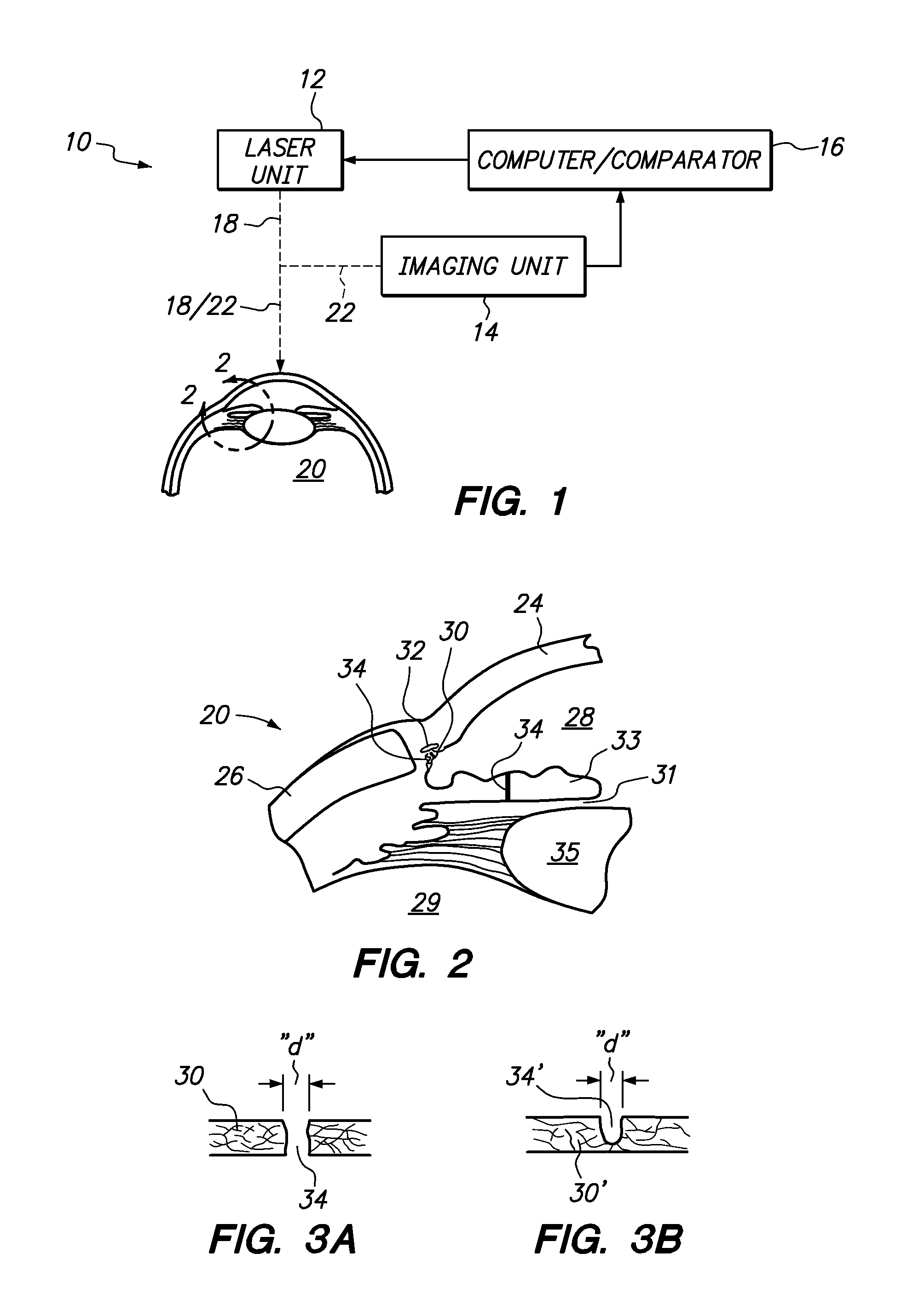 System and Method for Lowering IOP by Creation of Microchannels in Trabecular Meshwork Using a Femtosecond Laser