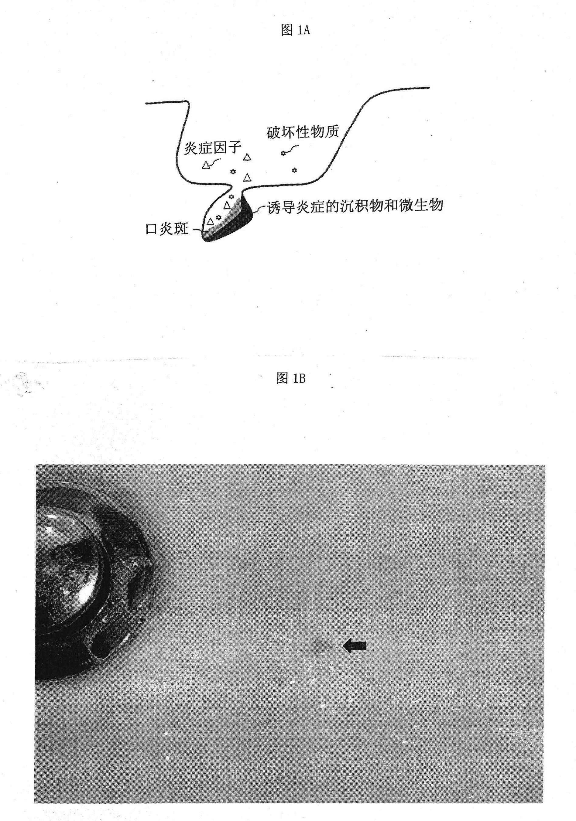 Tool for clearing stomatitis spots and stomatitis nodes, and application thereof