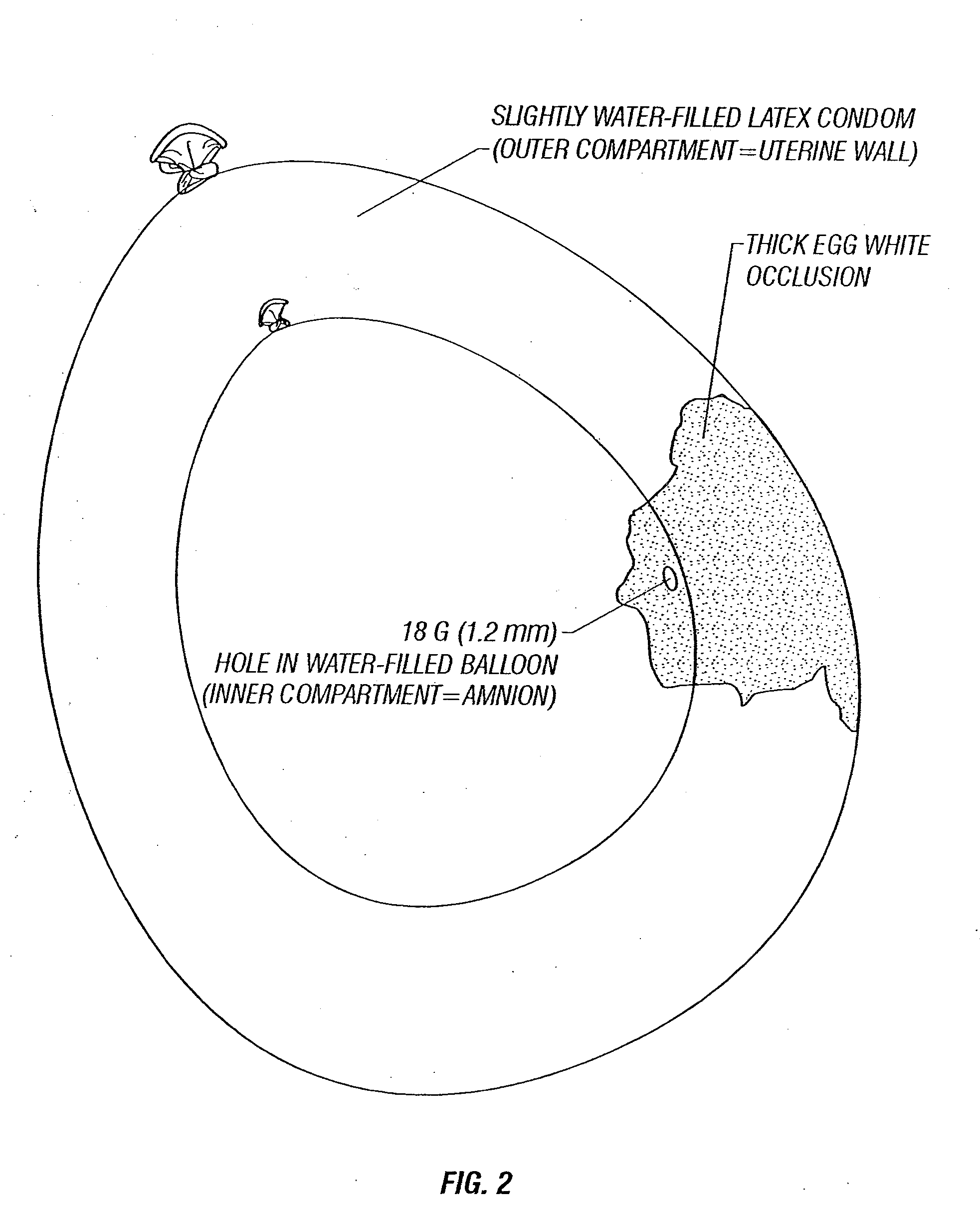 Repair of ruptured membrane by injection of naturally occurring protein in amniotic fluid sac