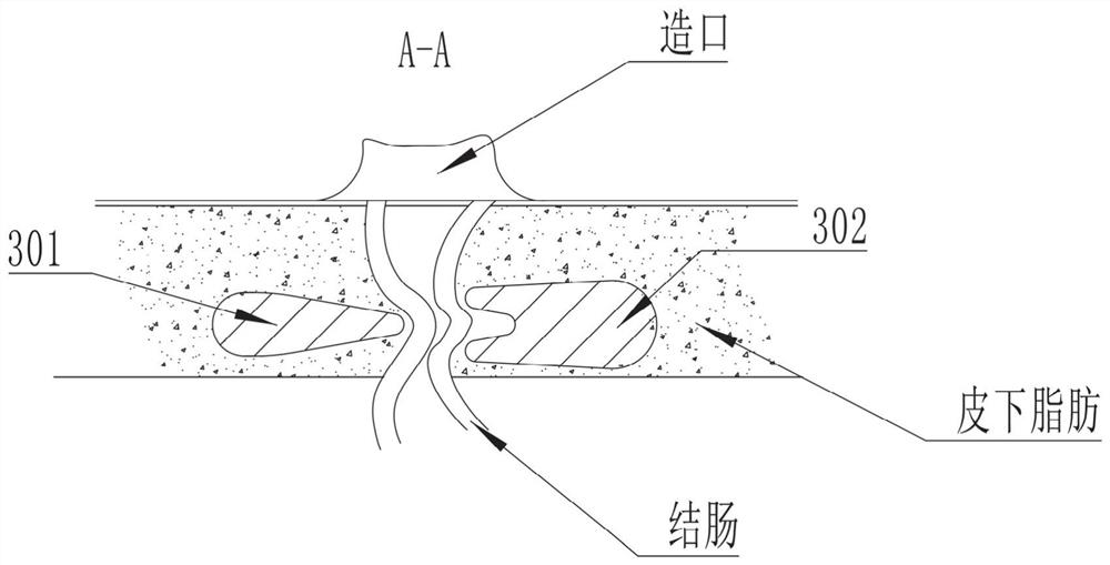 Colostomy plugging device