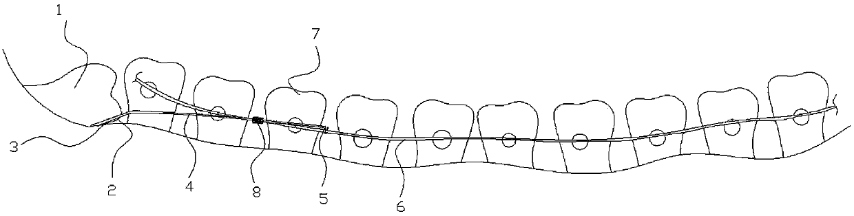 Correction auxiliary arch for impacted wisdom tooth