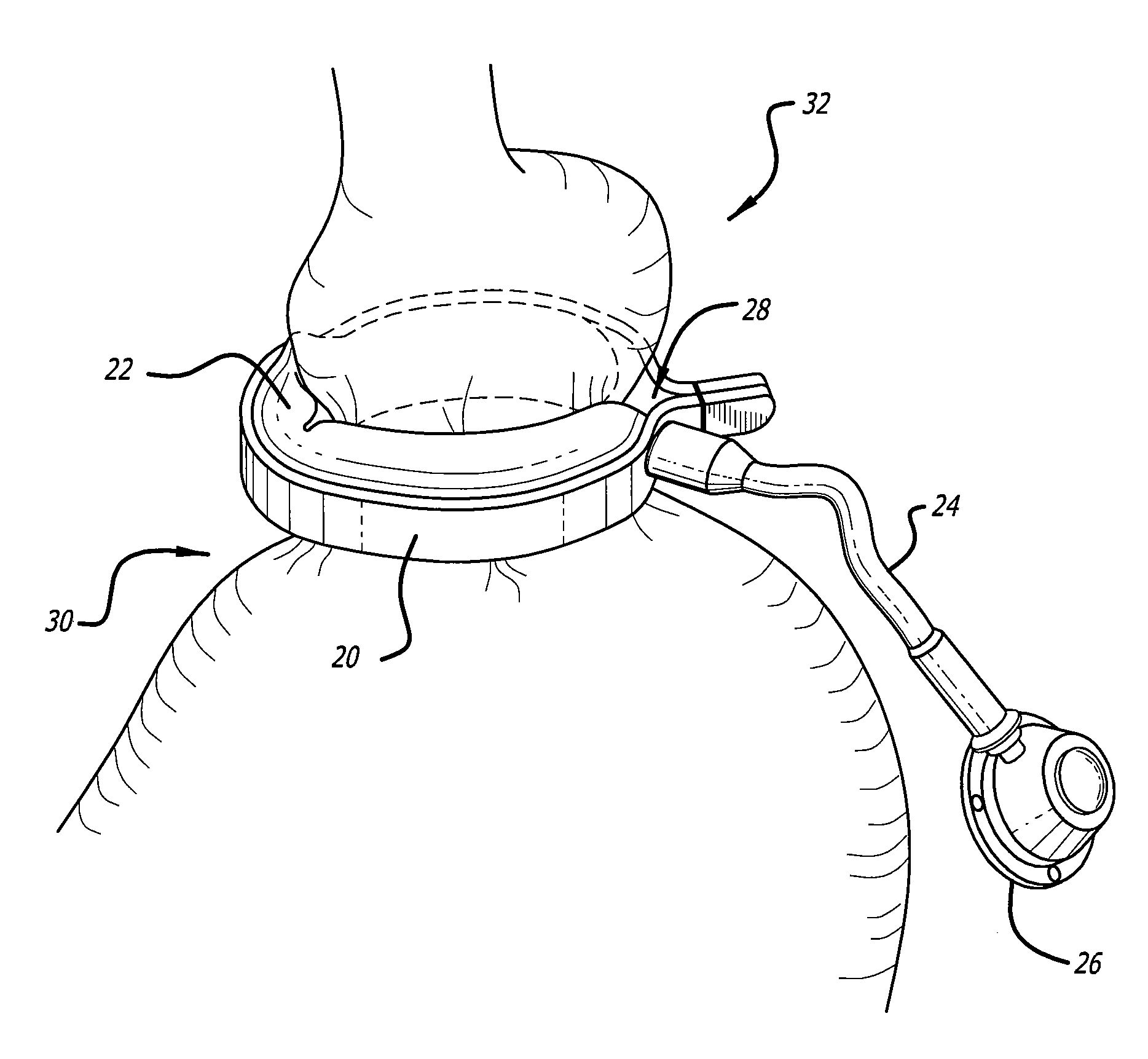 Assembly and method for automatically controlling pressure for a gastric band