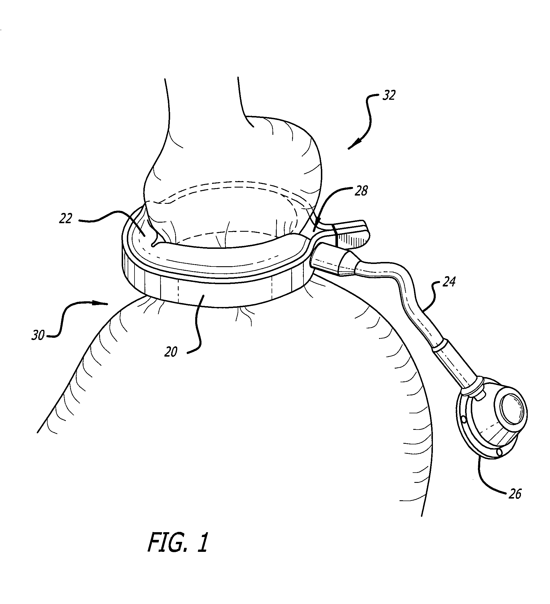 Assembly and method for automatically controlling pressure for a gastric band