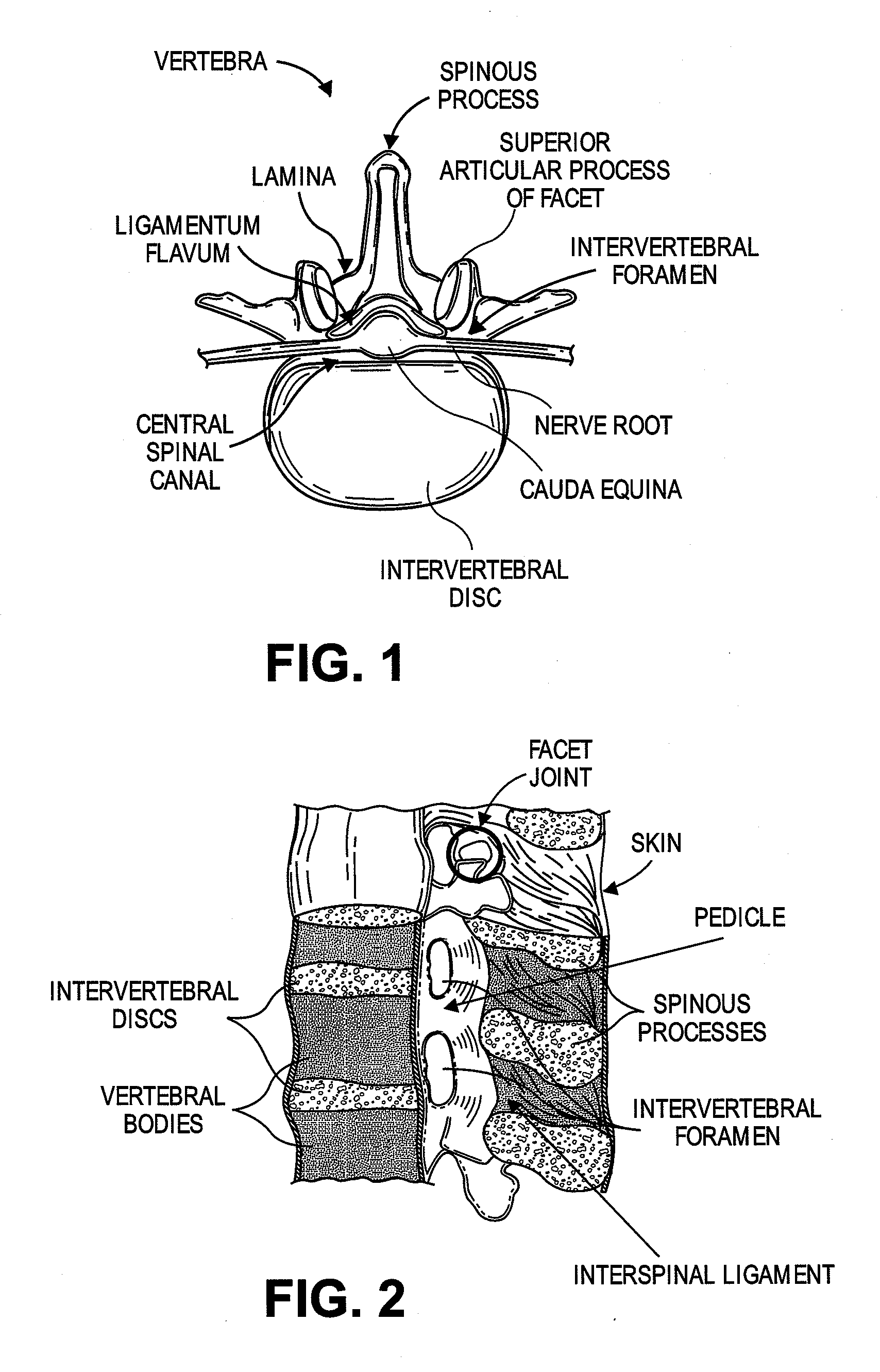 Multiple pathways for spinal nerve root decompression from a single access point