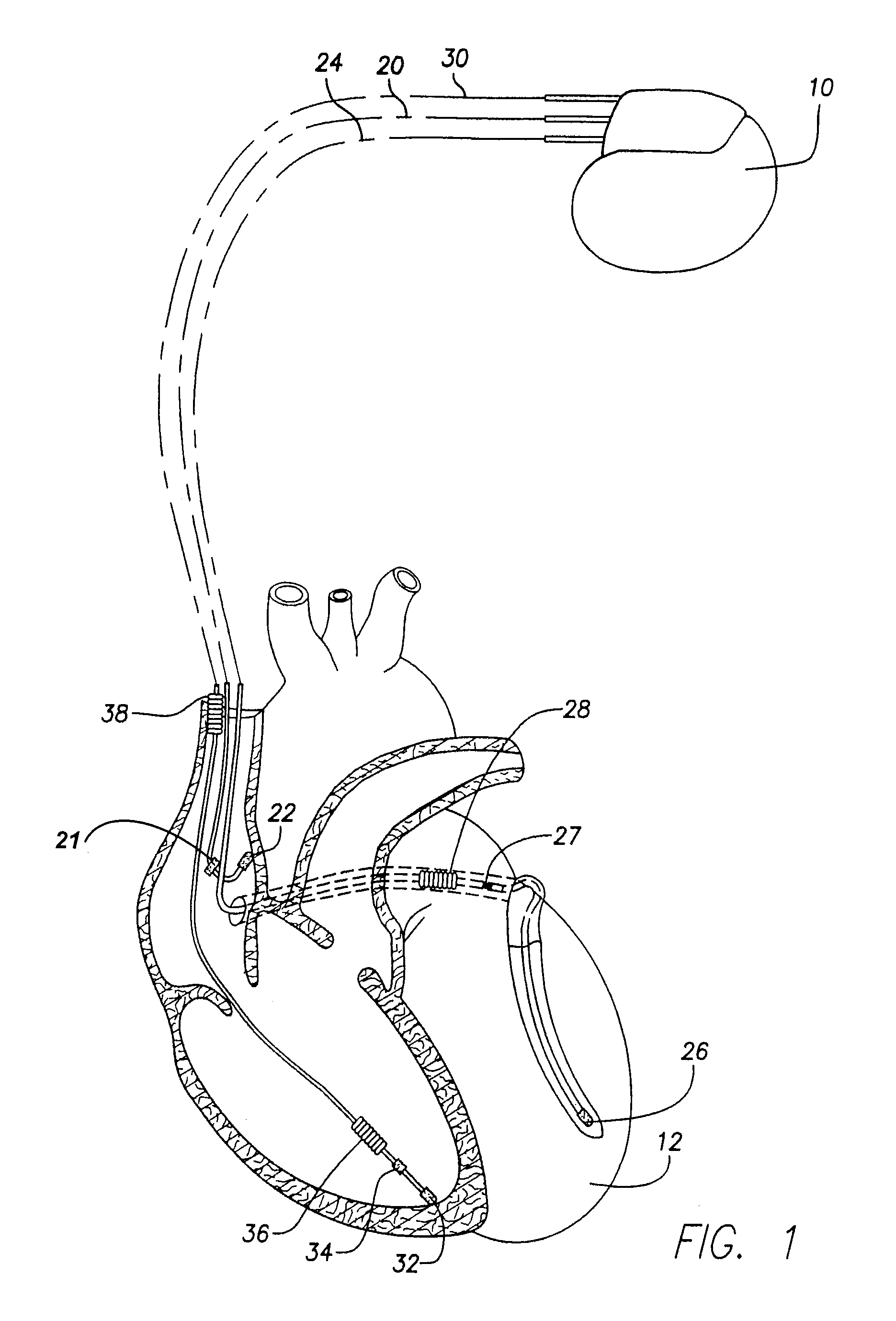 Systems and methods for preventing, detecting, and terminating pacemaker mediated tachycardia in biventricular implantable cardiac stimulation systems