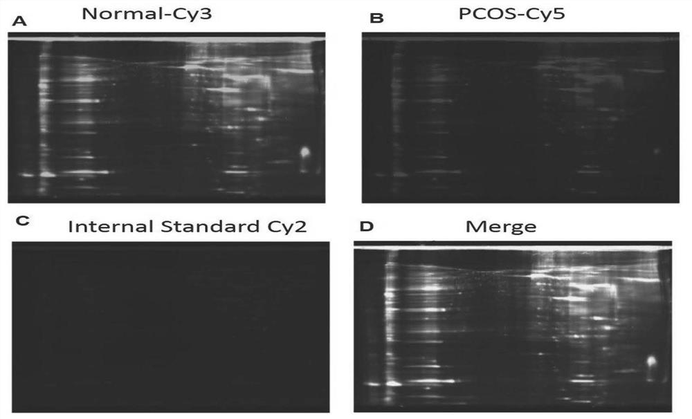 Application of preparation for regulating and controlling expression quantity of HSP90B1 in preparation of medicine for preventing or treating polycystic ovarian syndrome