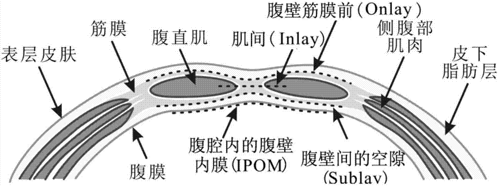 Lightweight incisional hernia patch three-dimensional ultrasonic image feature extraction method