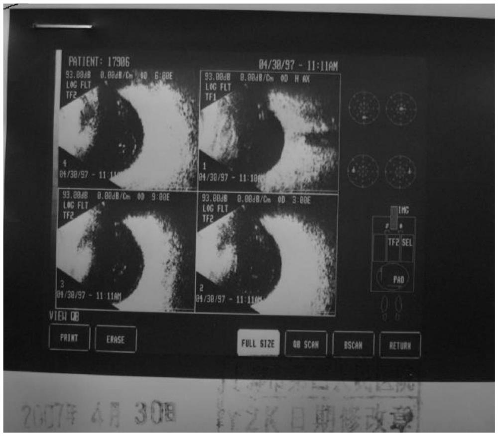 Traditional Chinese medicine composition for treating hemorrhagic eye diseases and preparation method of traditional Chinese medicine composition