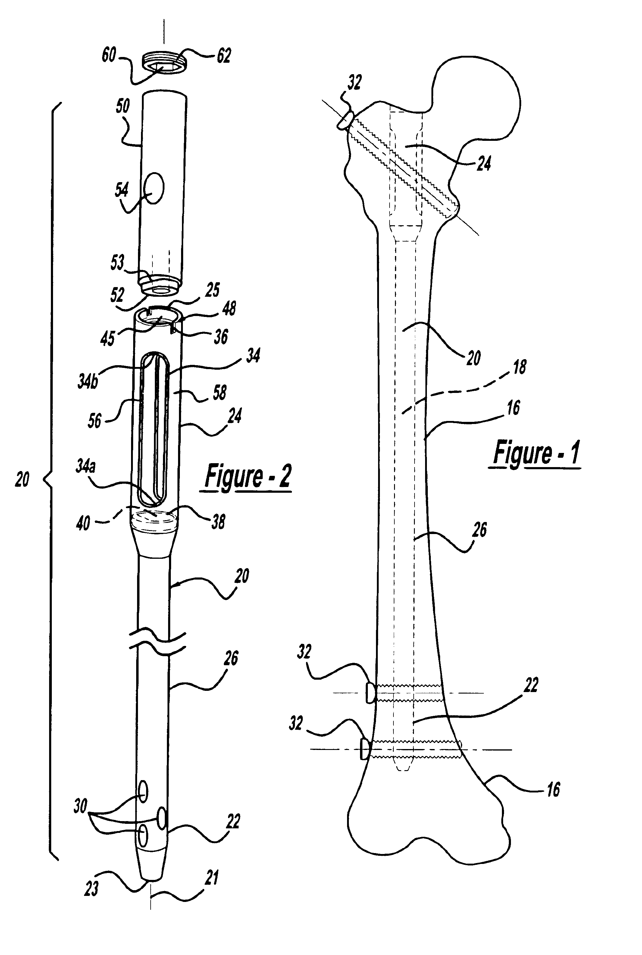 Modular intramedullary nail