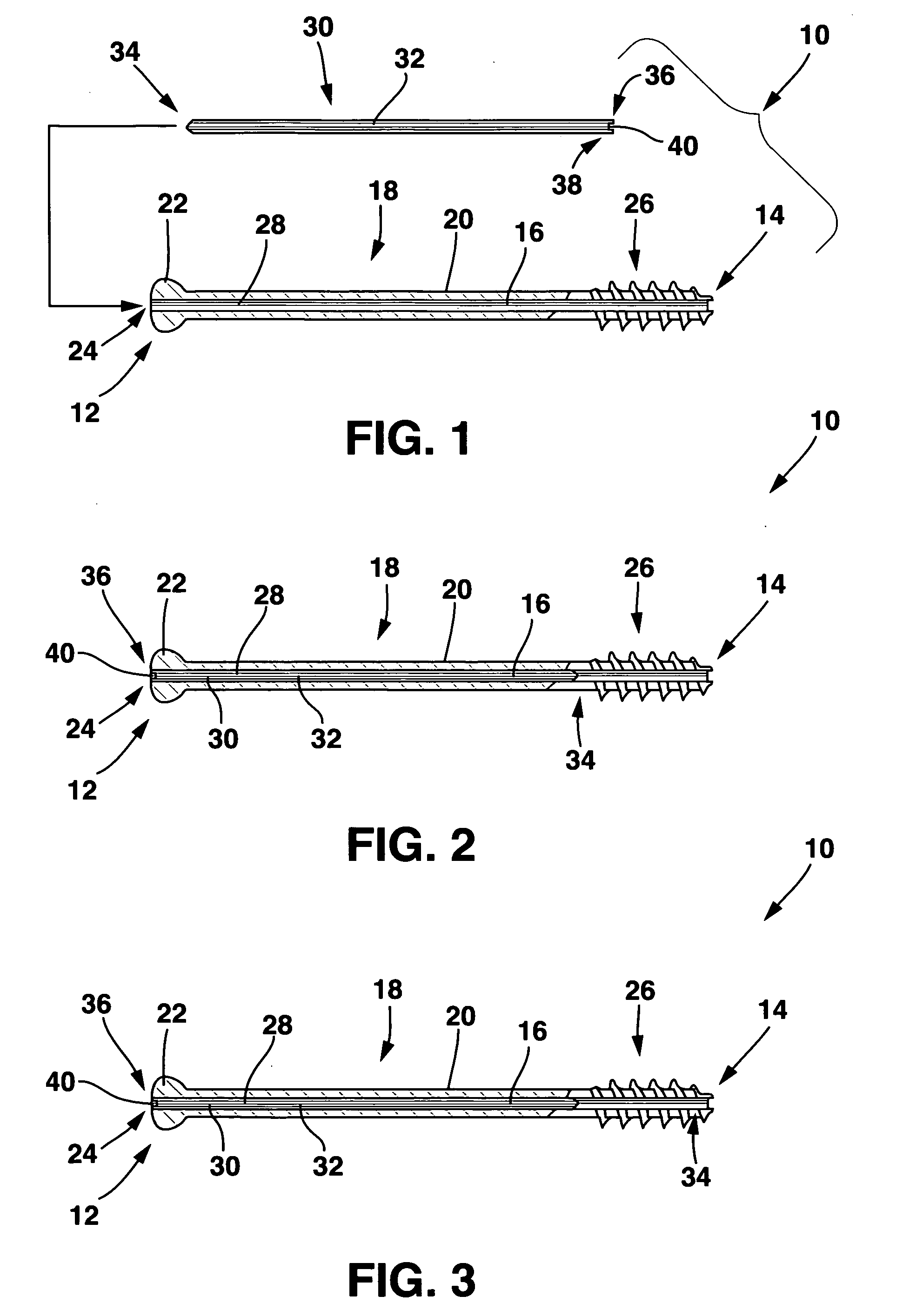 Fortified cannulated screw