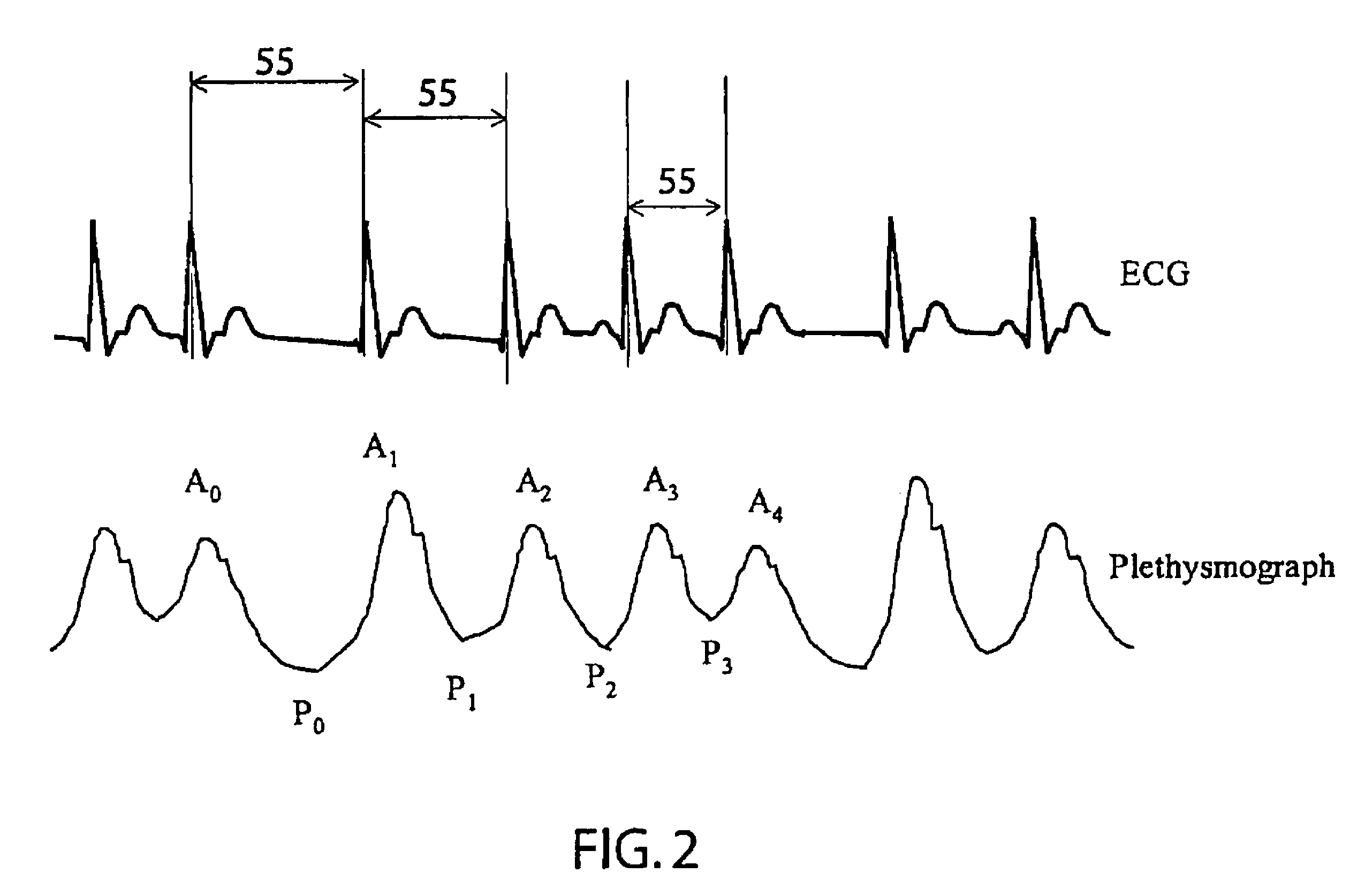 False positive reduction in SPO2 atrial fibrillation detection using average heart rate and NIBP