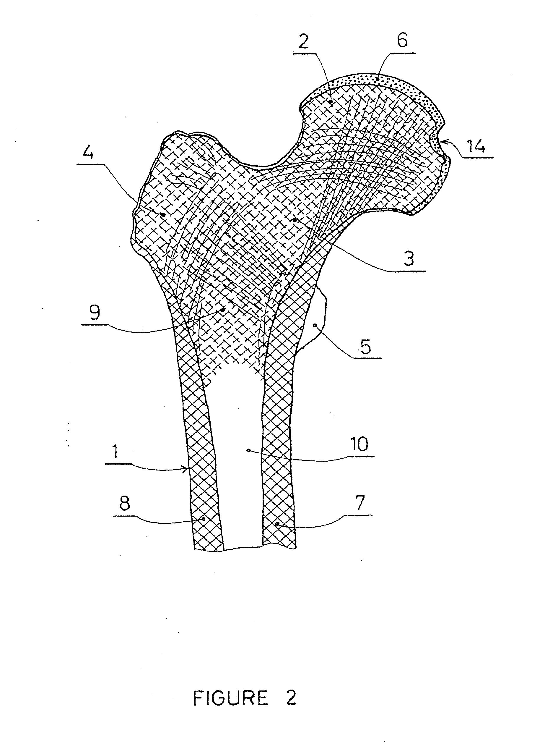 Partial hip prosthesis