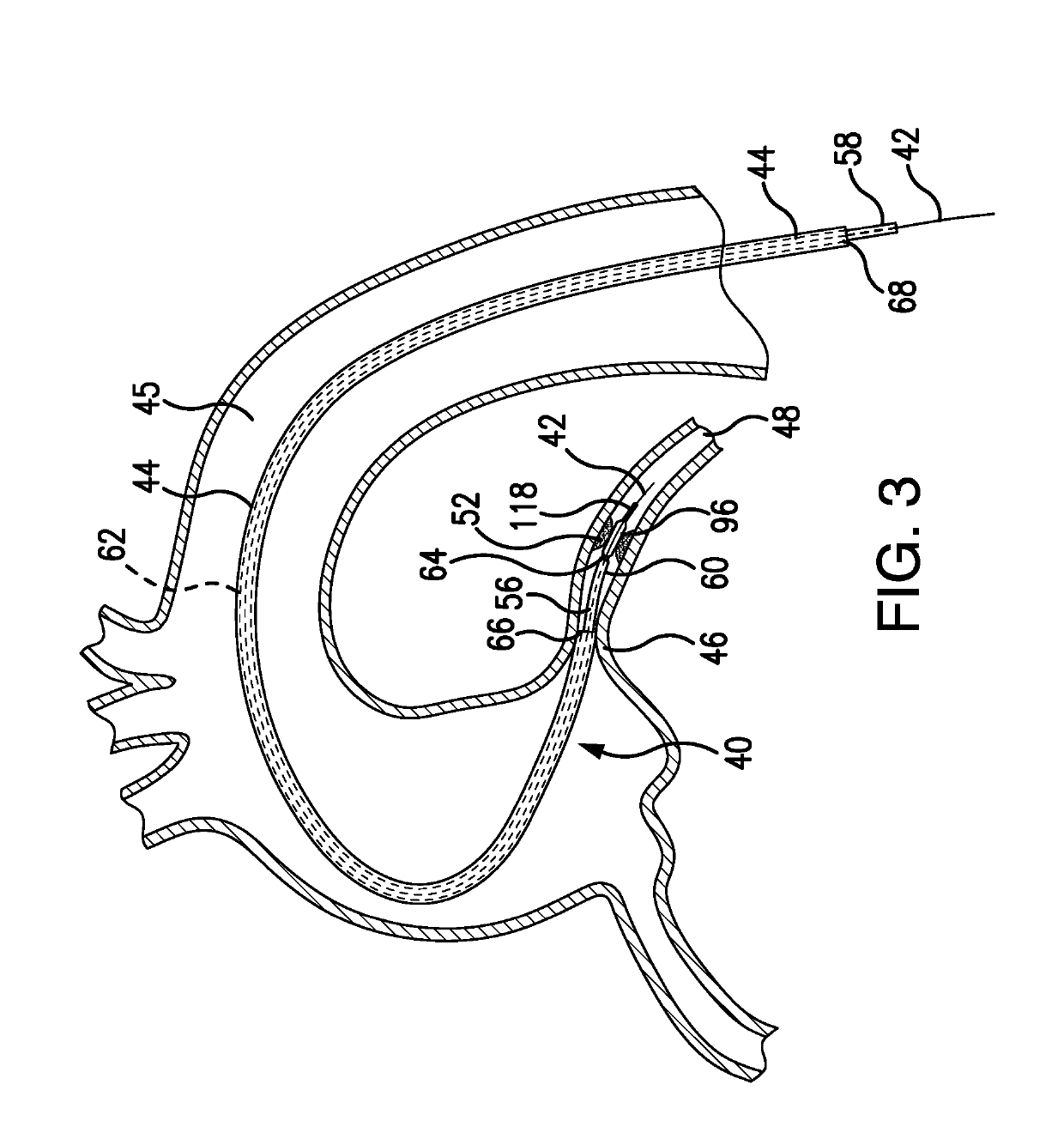 Intravascular delivery system and method for percutaneous coronary intervention