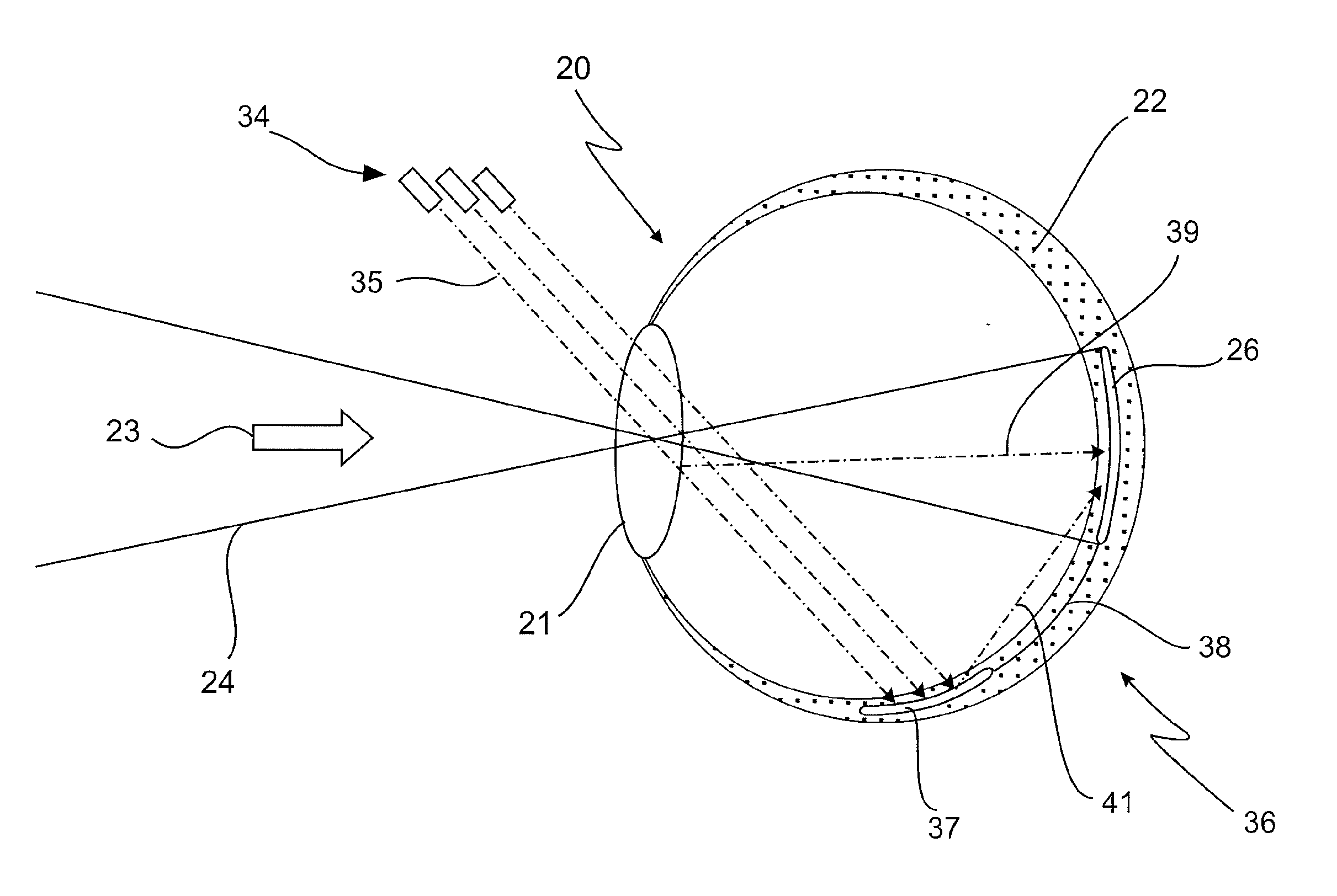 Active retinal implant