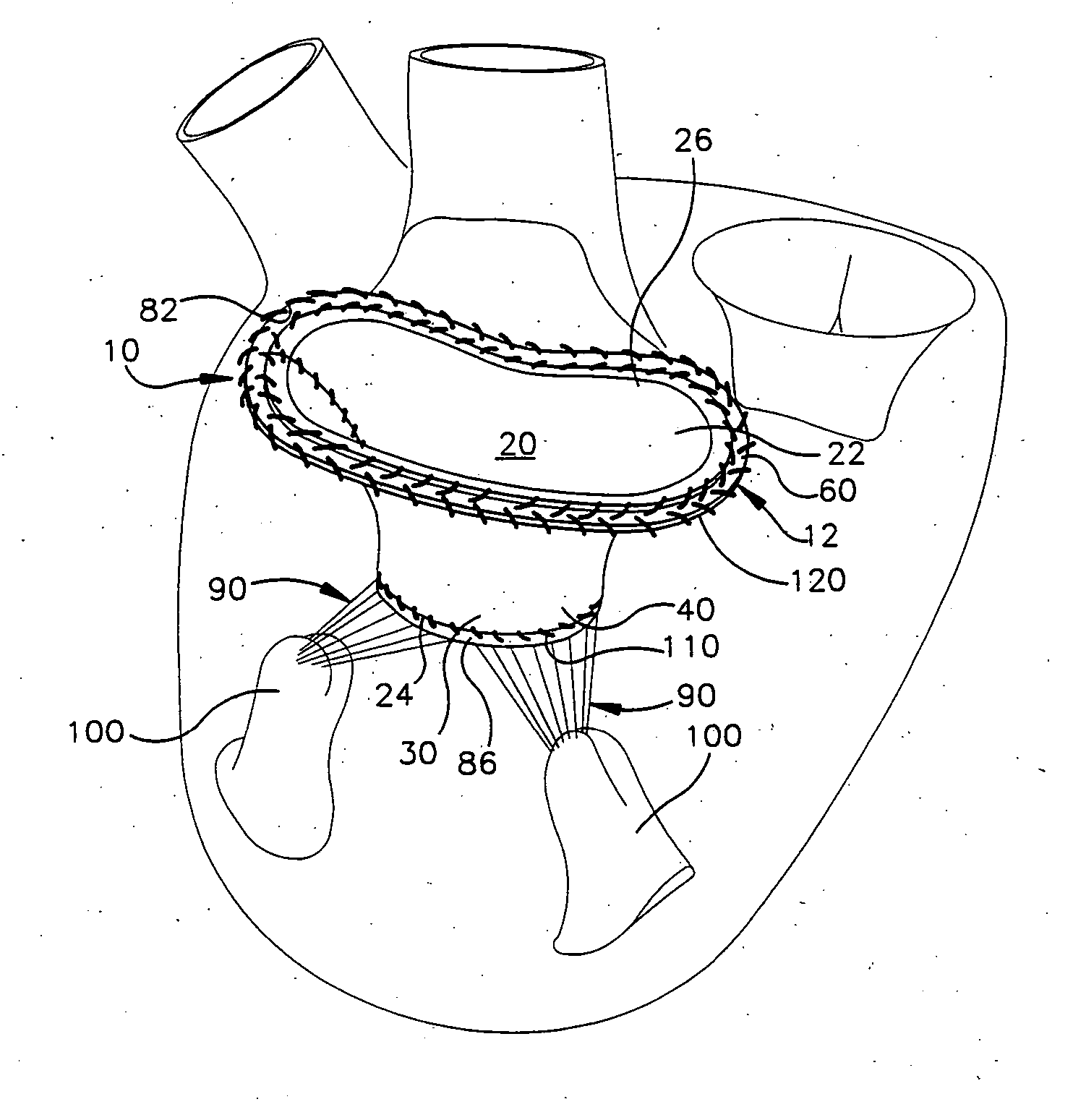 Method and apparatus for replacing a mitral valve with a stentless bioprosthetic valve