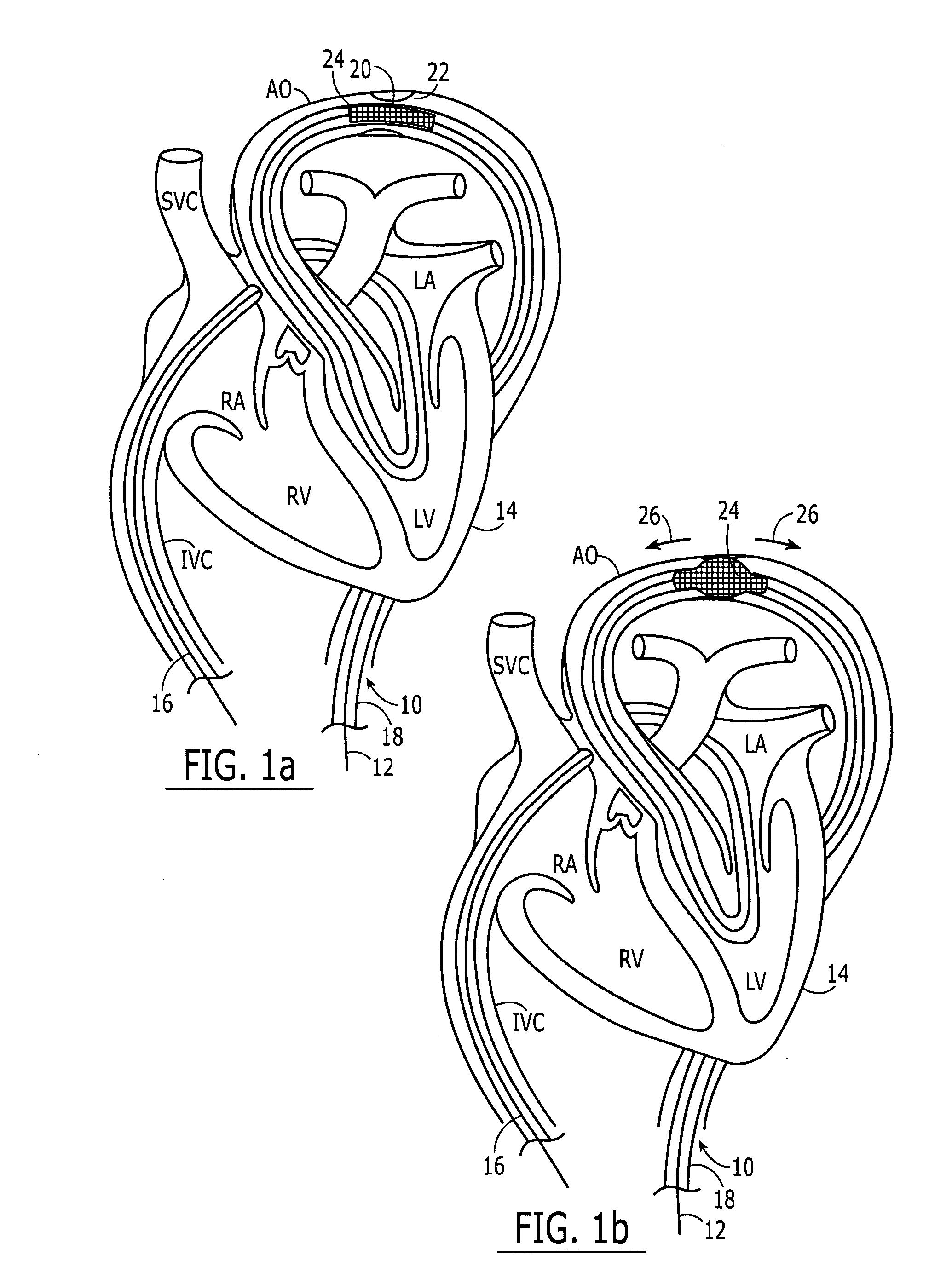 Separable sheath and method for insertion of a medical device into a bodily vessel using a separable sheath