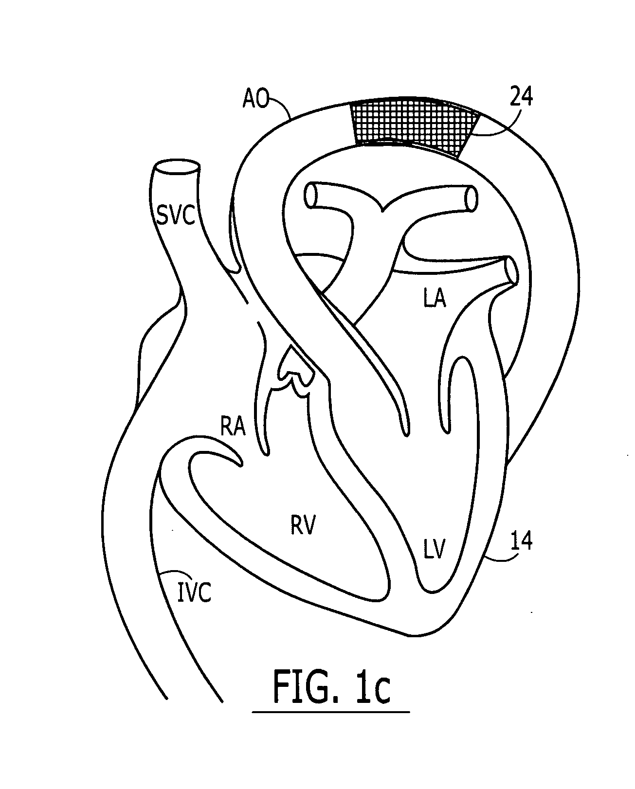 Separable sheath and method for insertion of a medical device into a bodily vessel using a separable sheath