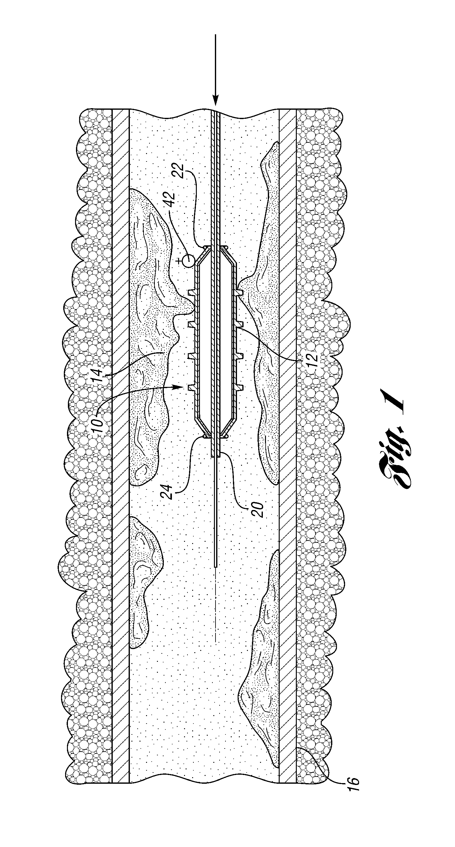 Catheter system with balloon-mounted plaque-modifying elements