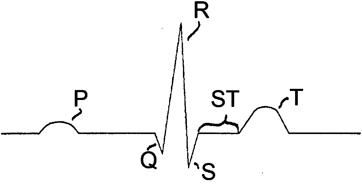 Data processing apparatus for assessing a condition of a myocardium