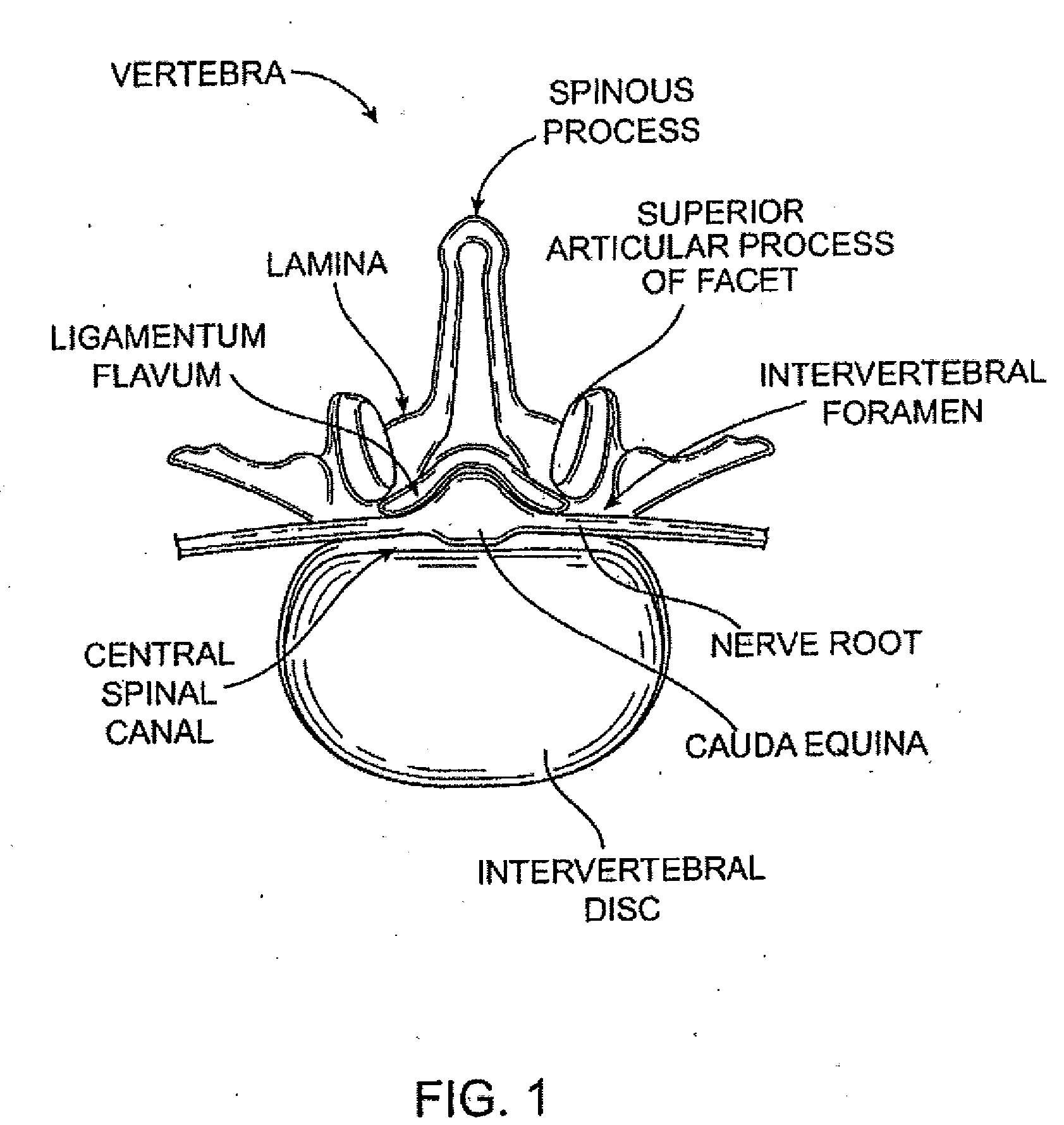 Tissue removal devices and methods