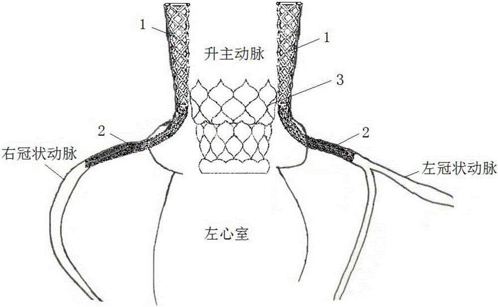 Coronary artery protecting device