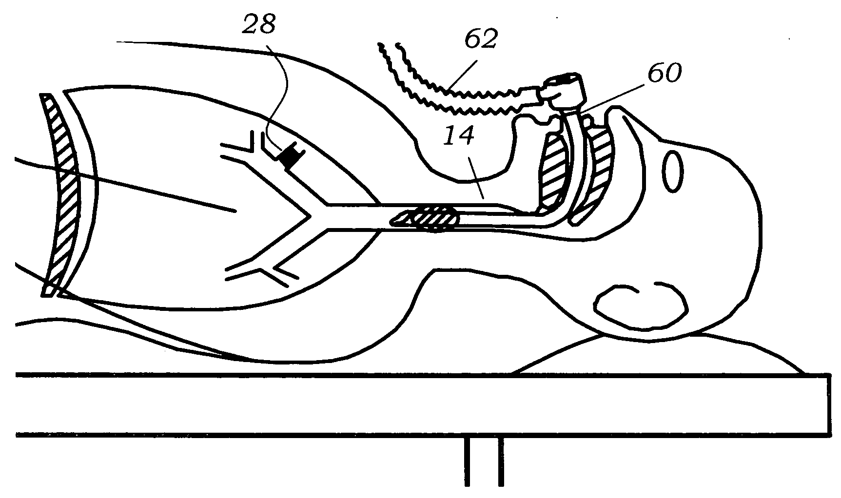 Methods, systems & devices for endobronchial ventilation and drug delivery