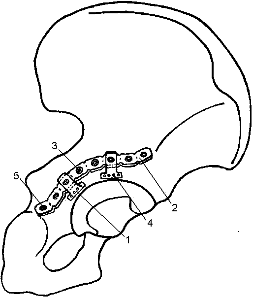 Combined internal fixator for fixing laparoscopic gastric banding