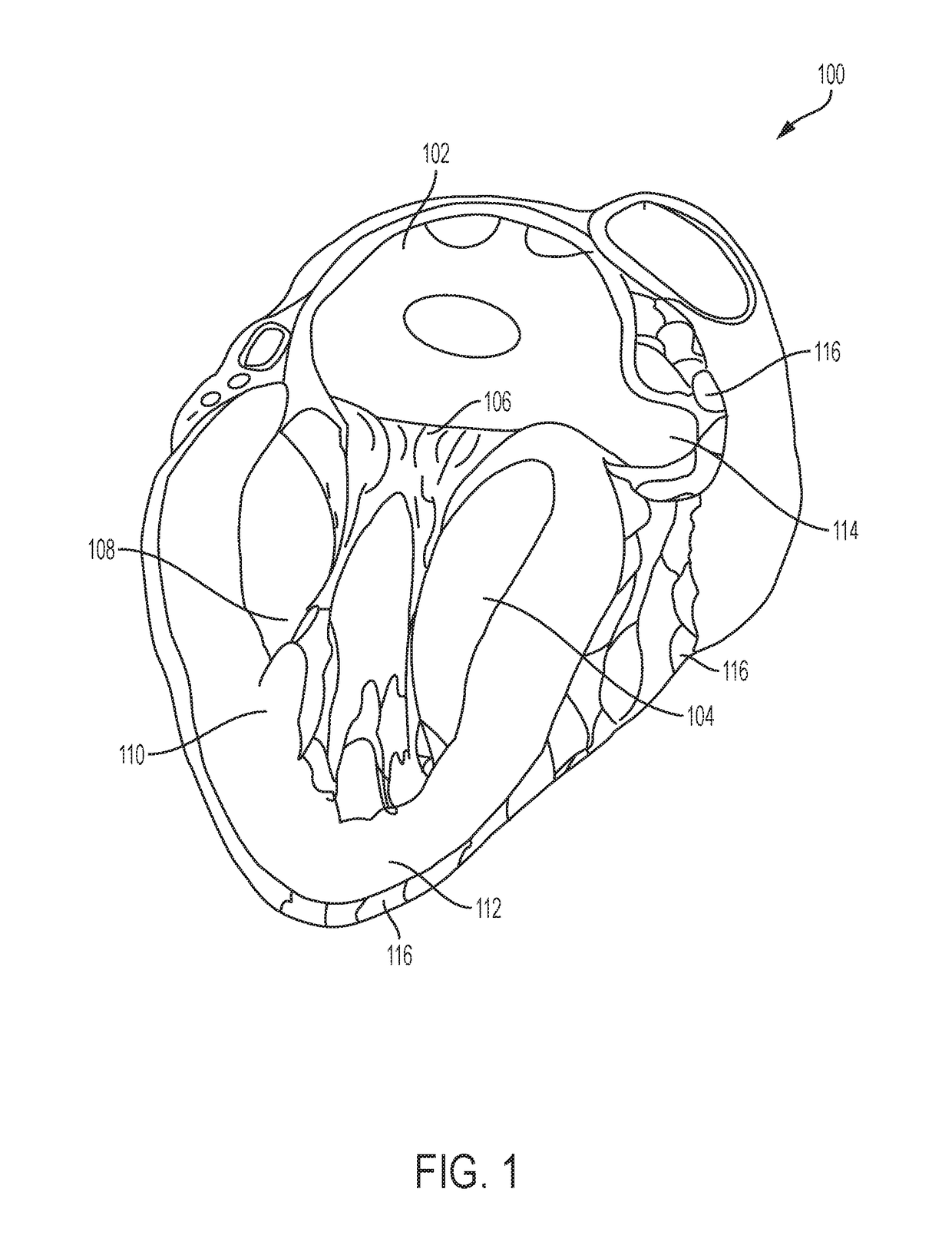 Devices and methods for left atrial appendage closure