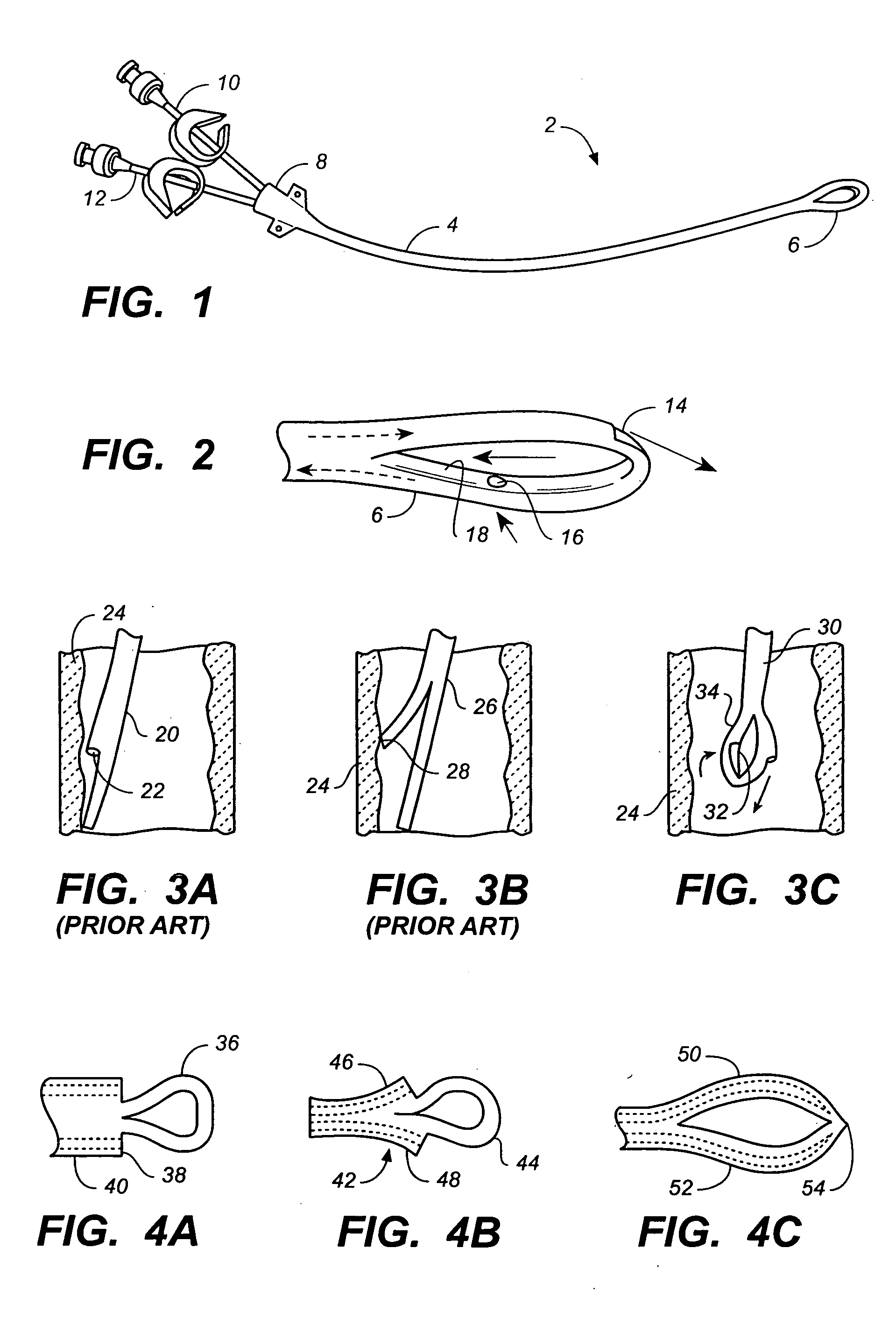 Loop-tip catheter