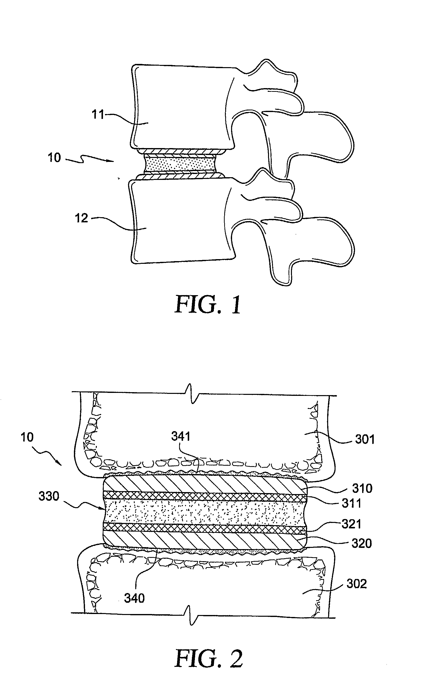 Fixation of Elastomer to Rigid Structures