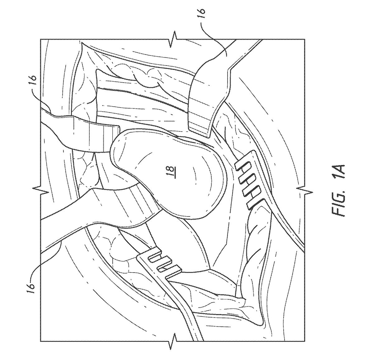 Guides and instruments for improving accuracy of glenoid implant placement